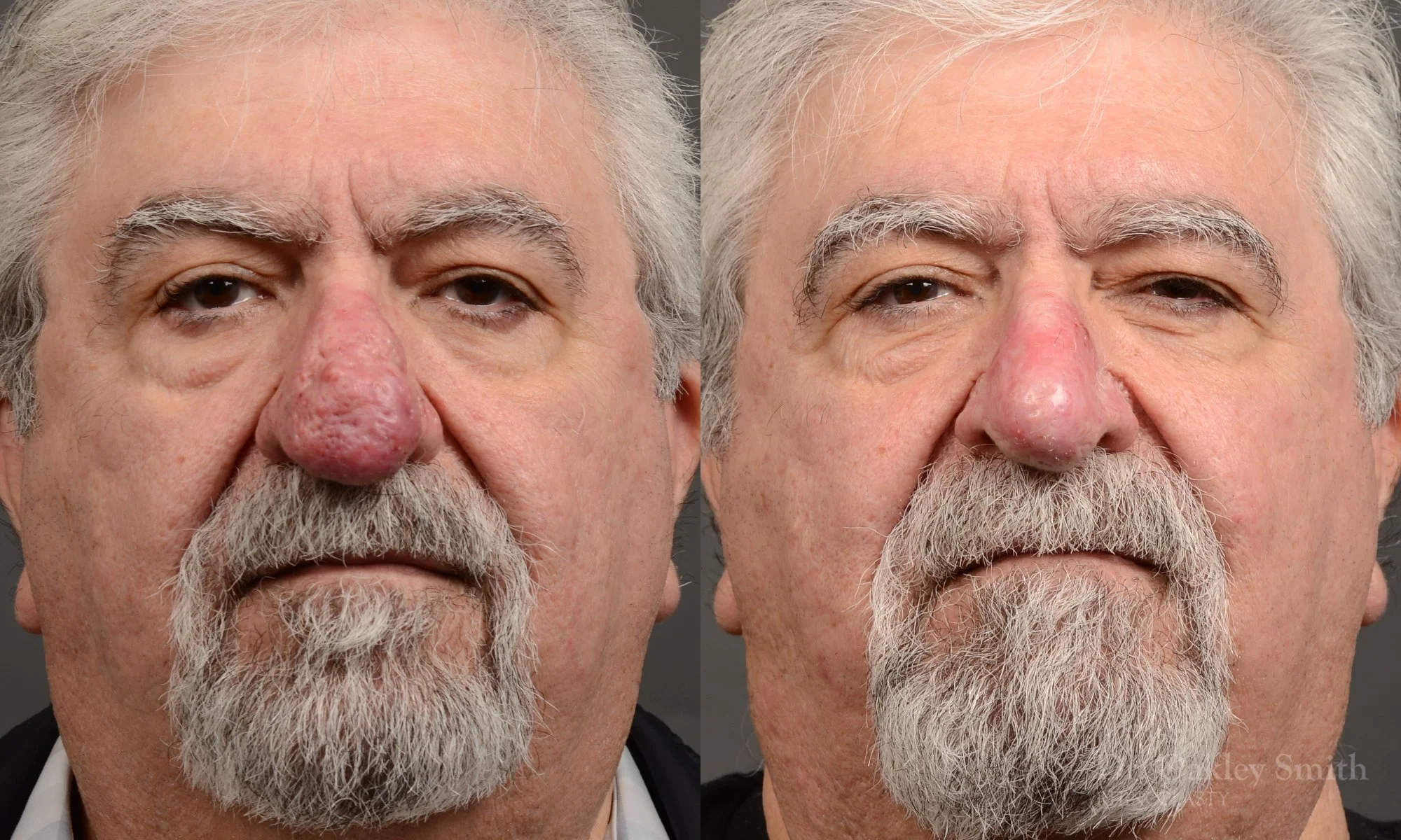 Case 562, Dr. Oakley Smith, rhinophyma rhinoplasty, 12 months after surgery, frontal view