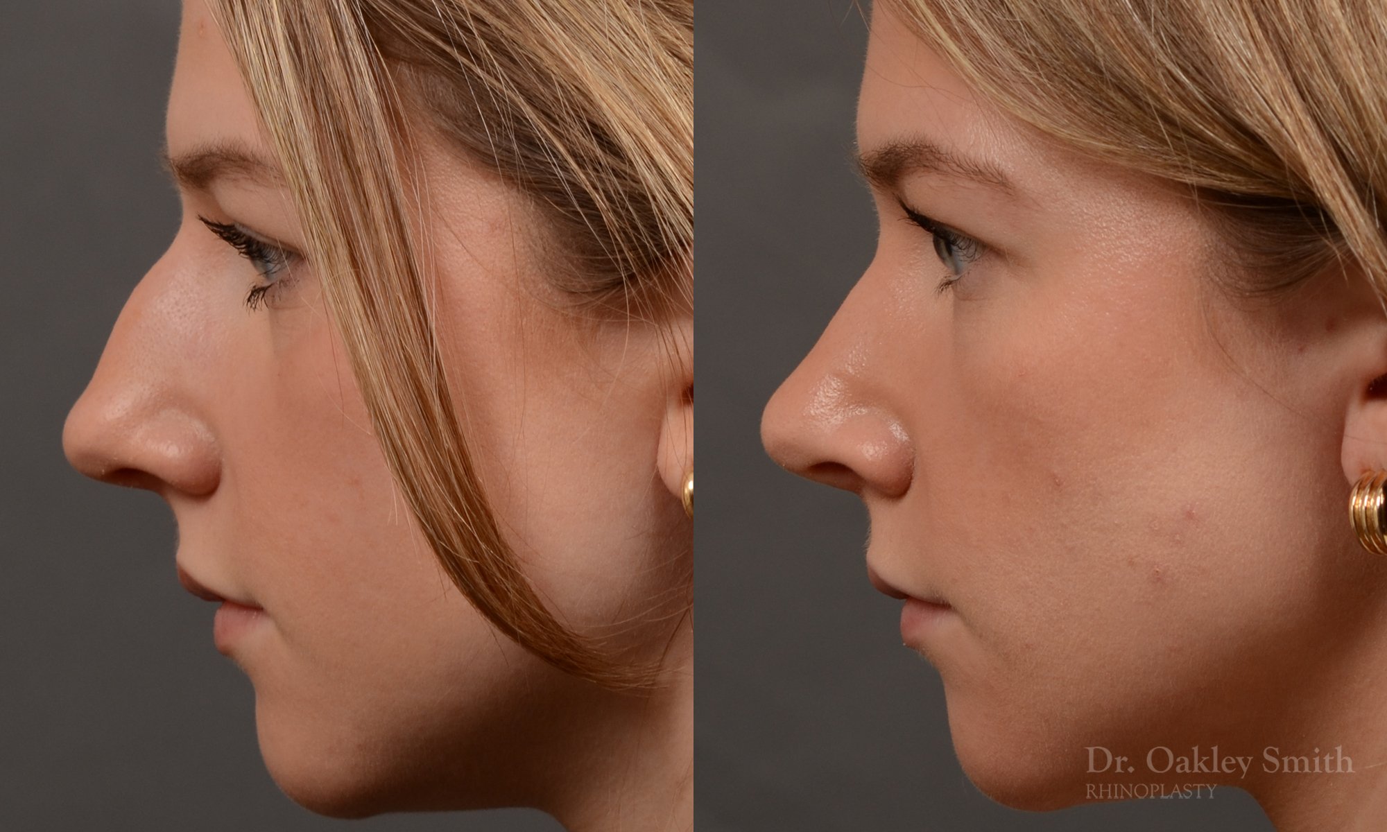 536E-rhinoplasty-dr.-oakley-smith-toronto-nose-job-best.jpg