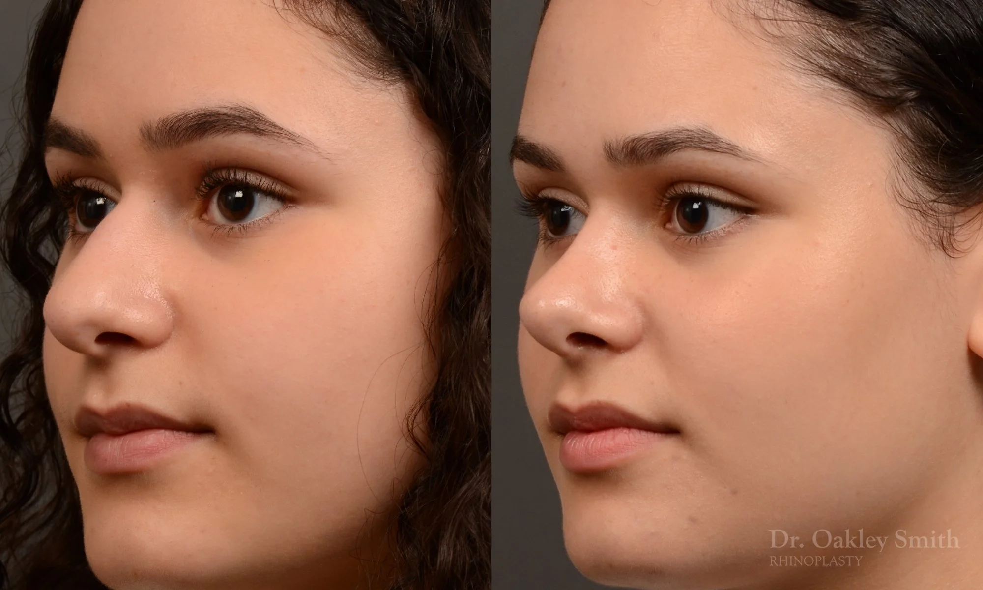 543D-rhinoplasty-before-and-after-nose-job-toronto-Dr.-Oakley-Smith.jpg