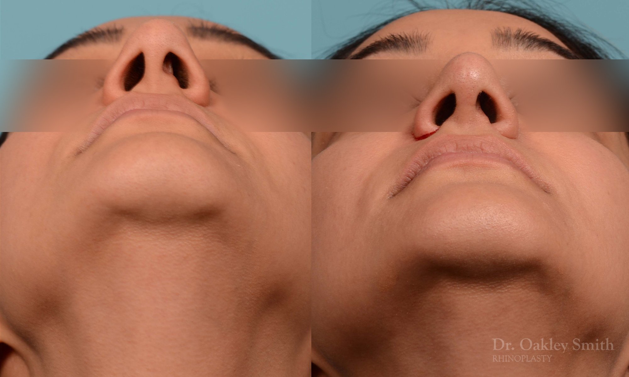 223F-nose-job-long-nose-rhinoplasty-dr-oakley-smith-curved-nose-wide-base-of-nose-projected-tip-weir-incisions-1-1.jpg