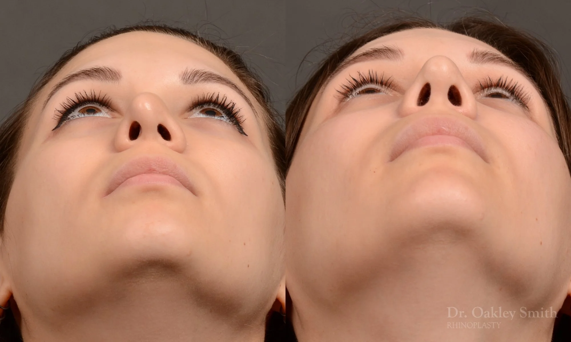 542F-rhinoplasty-before-and-after-nose-job-toronto-Dr.-Oakley-Smith.jpg