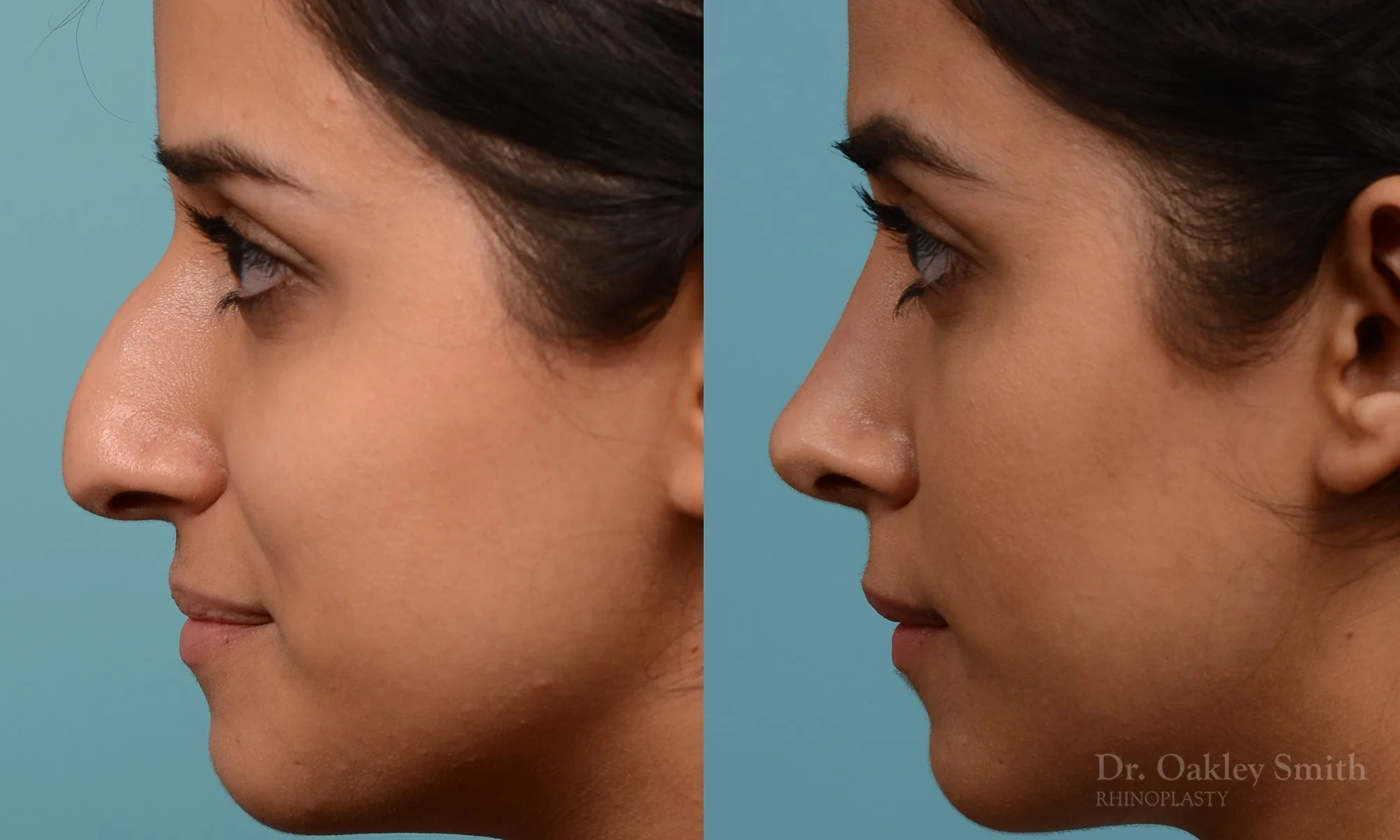 228E-nose-job-rhinoplasty-dr-oakley-smith-toronto-bump-on-the-nose-bridge-bump-4.jpg
