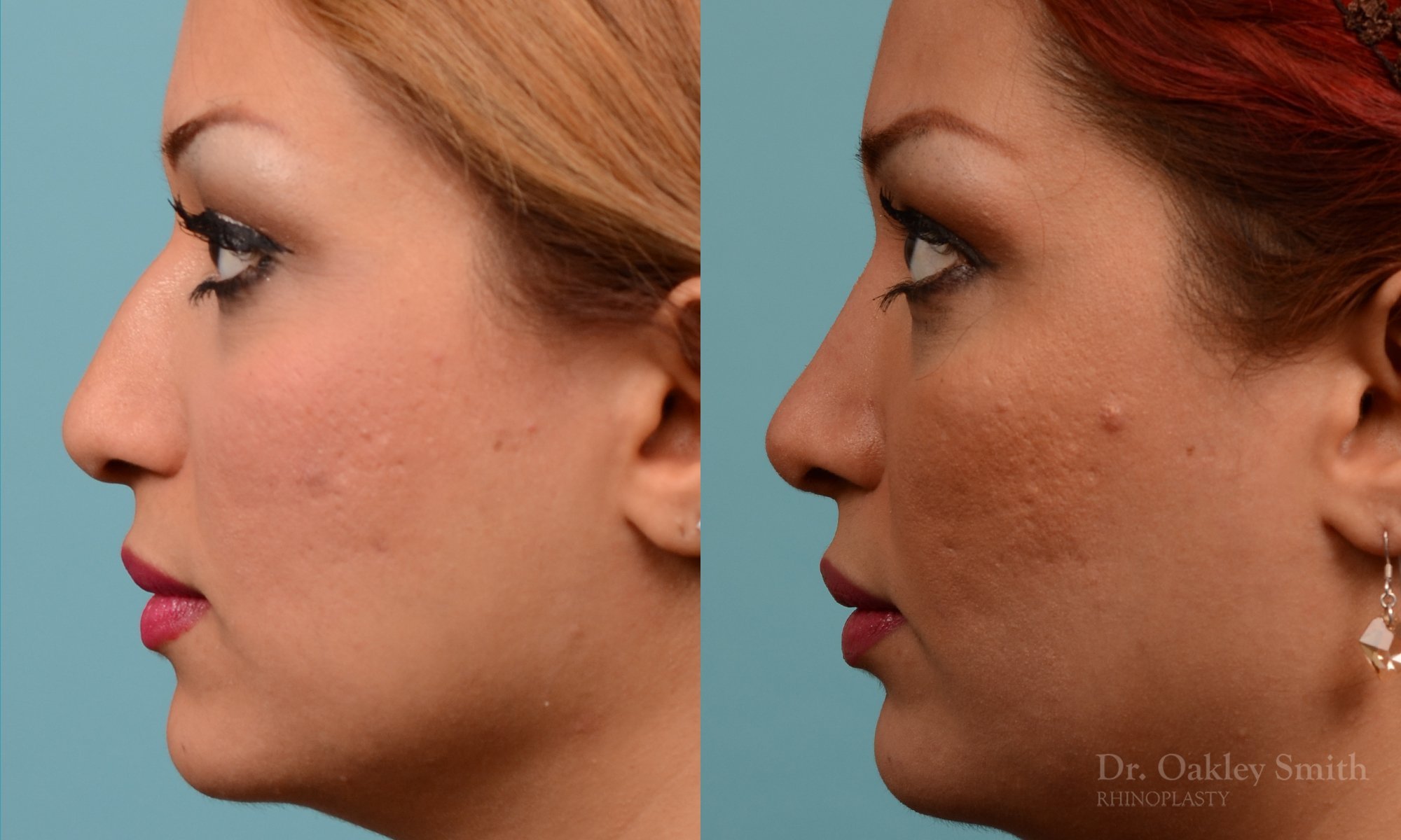 260E-rhinoplasty-dr-oakley-smith-toronto-nose-job.jpg