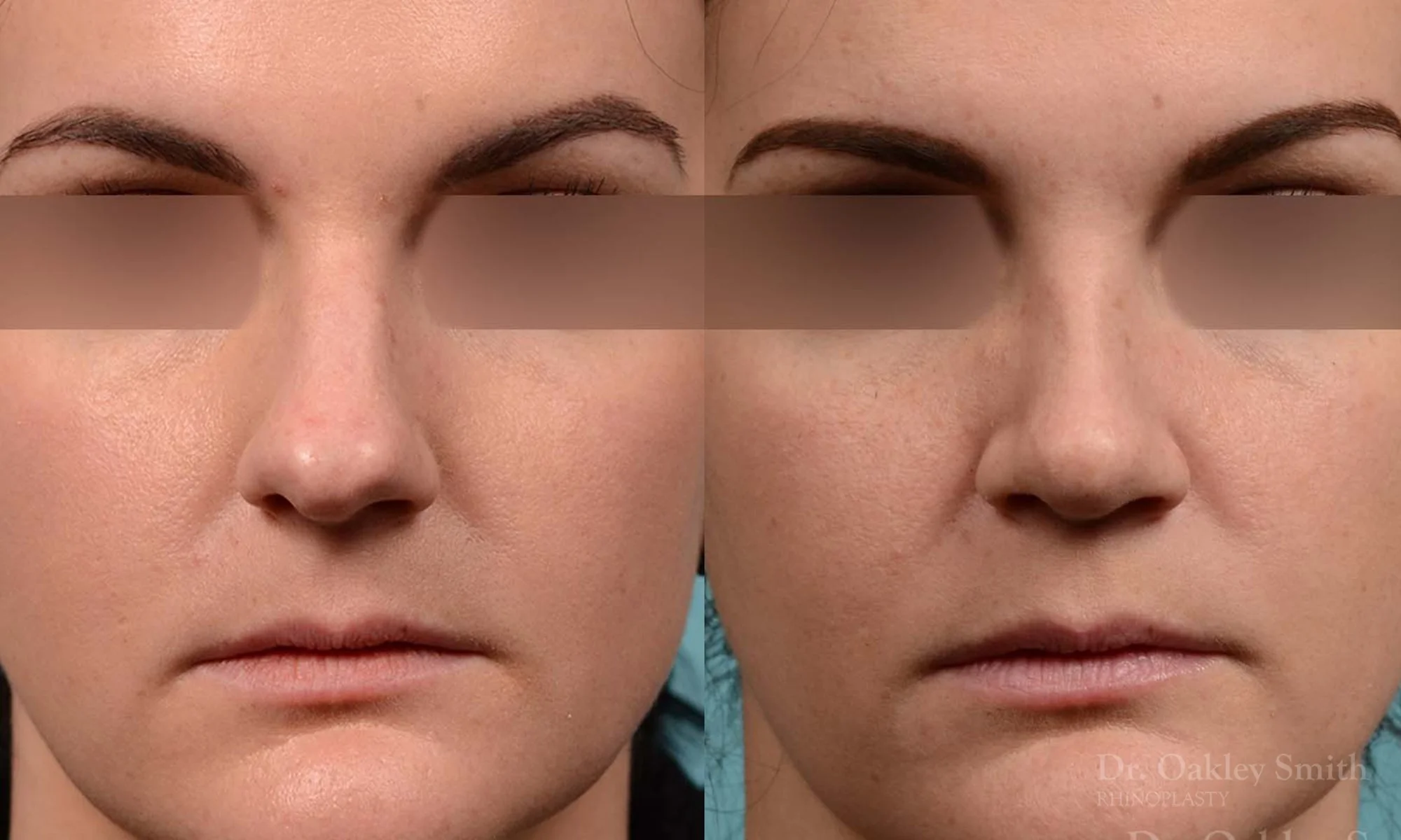 252A-rhinoplasty-dr-oakley-smith-toronto-nose-job.jpg