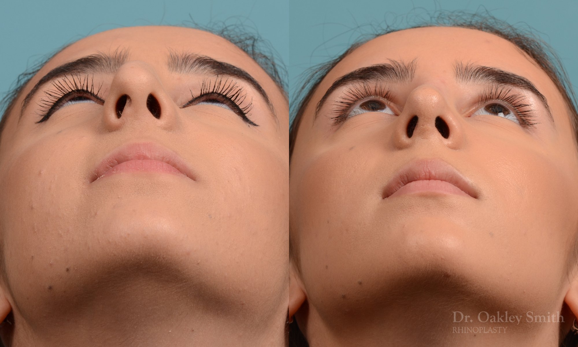 301F-rhinoplasty-dr-oakley-smith-toronto-nose-job (1).jpg