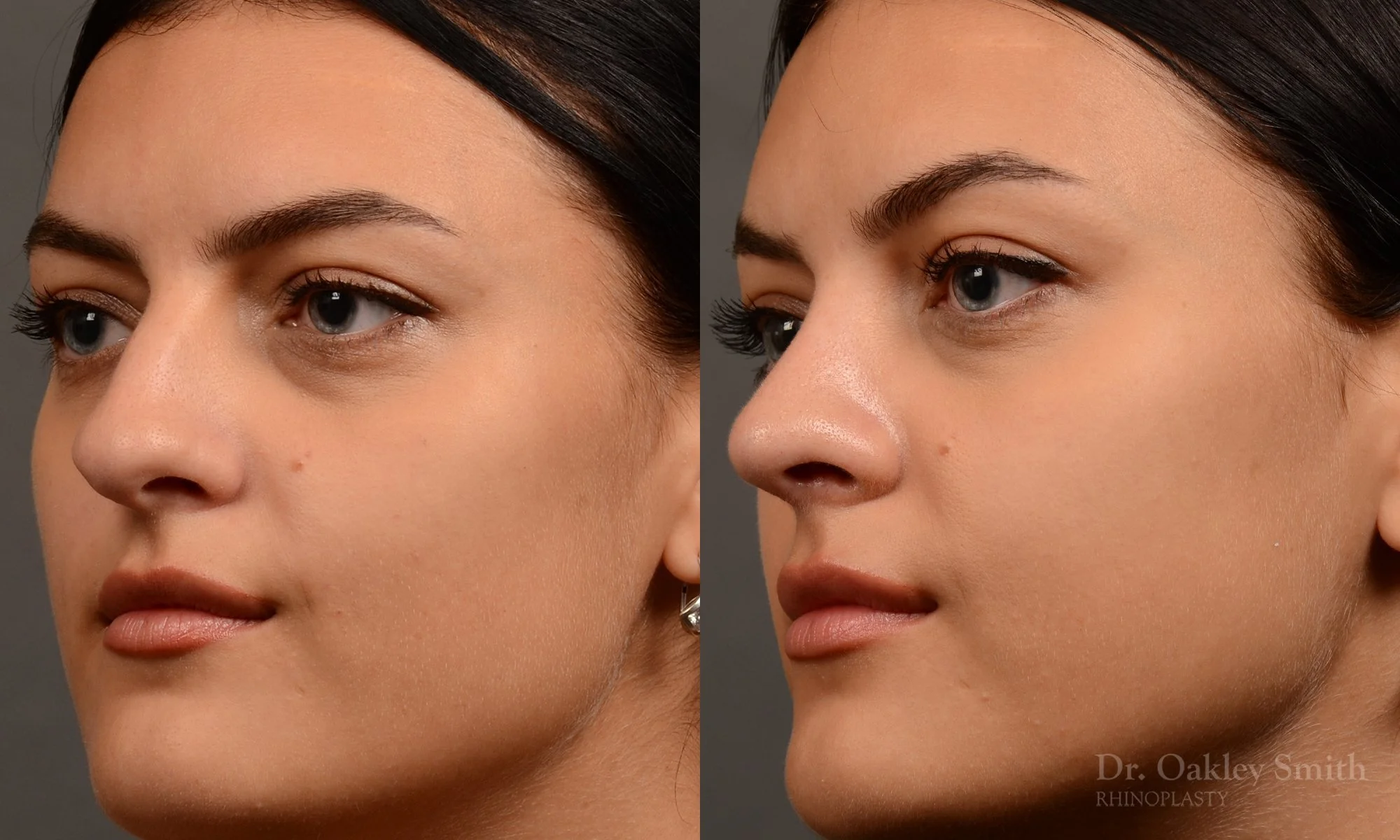 496D-rhinoplasty-dr-oakley-smith-toronto-top-surgeon-nose-job.jpg