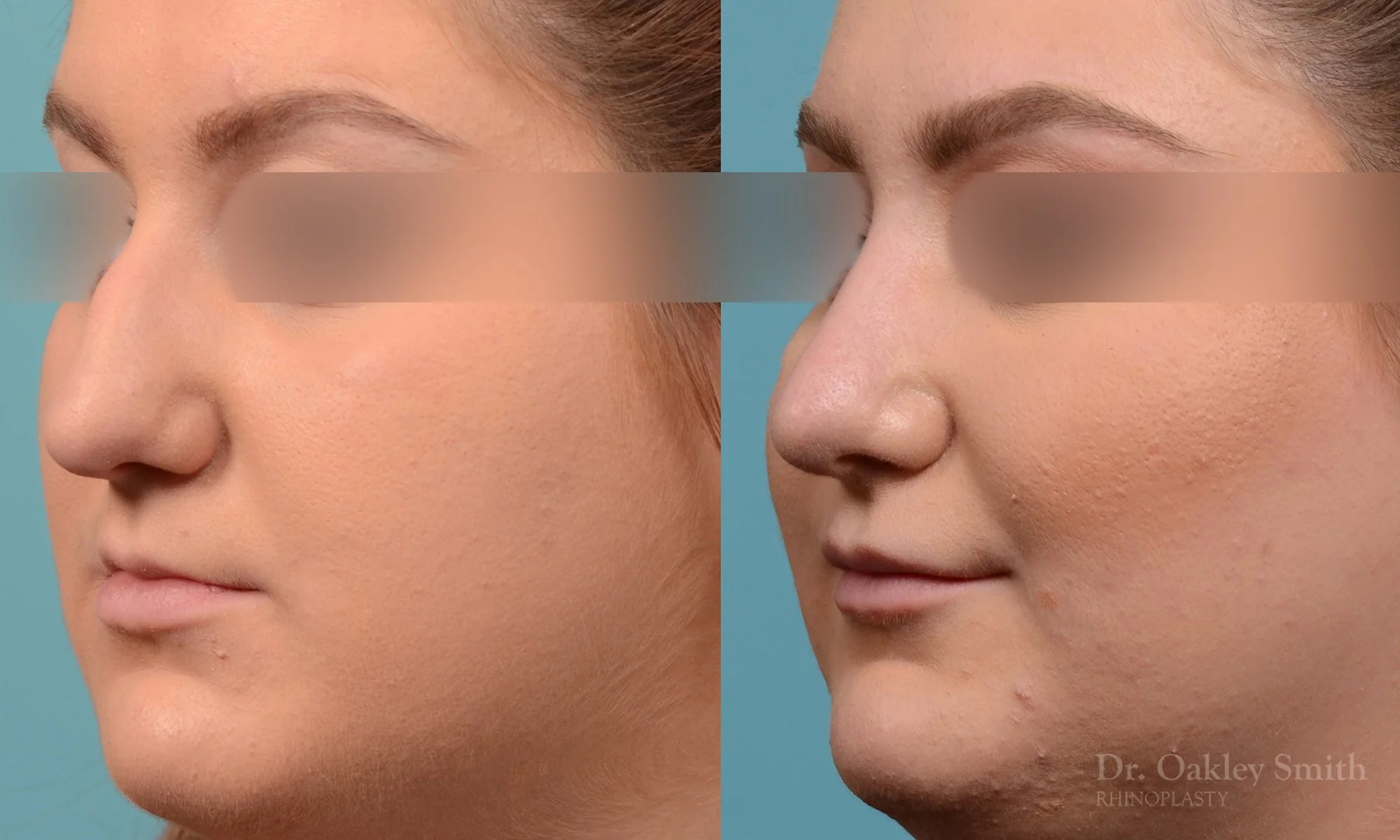 235D-watermark-curved-nose-nose-job-dr-oakley-smith-toronto-rhinoplasty-bump-on-bridge.jpg