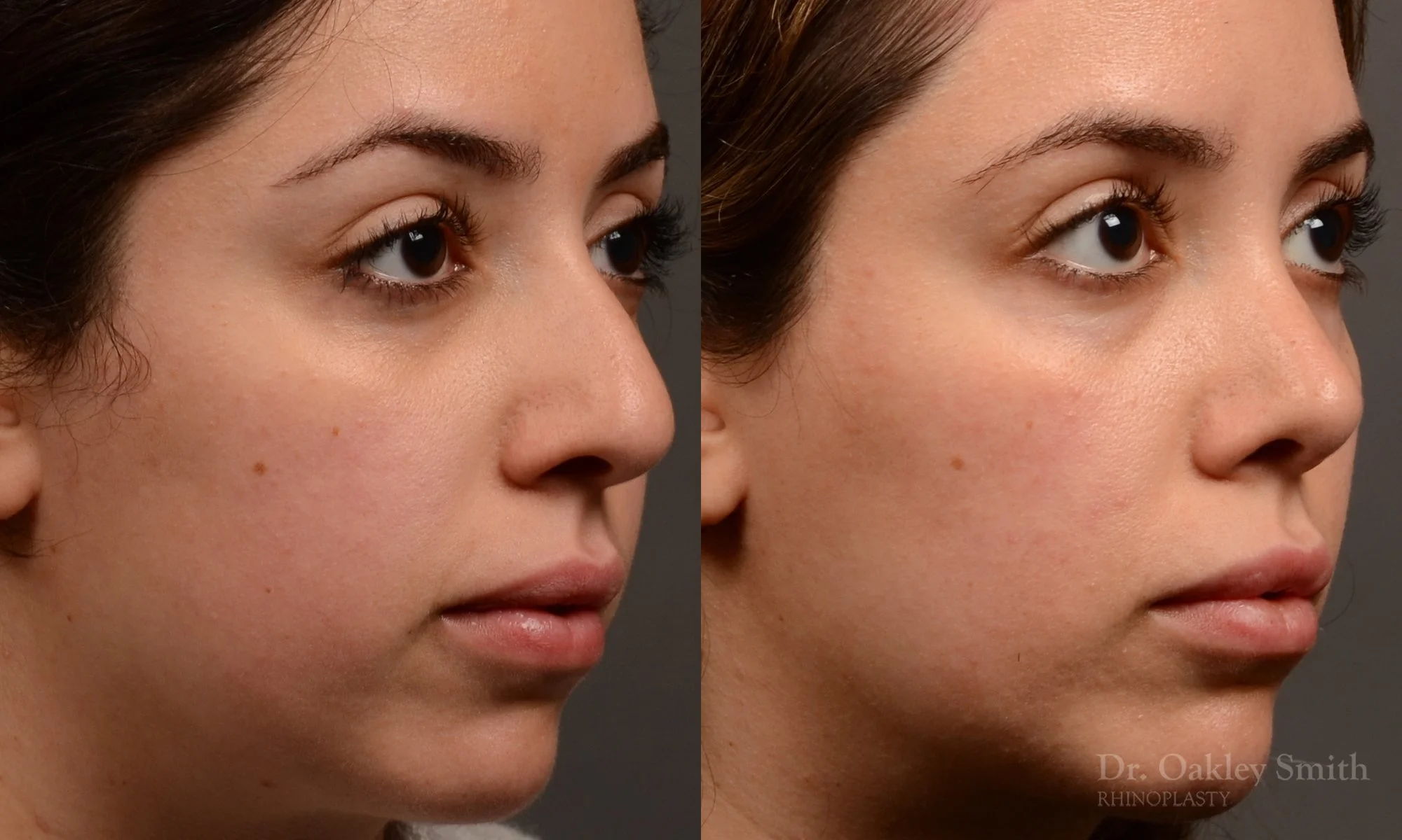 507B-rhinoplasty-dr-oakley-smith-toronto-top-surgeon-nose-job.jpg