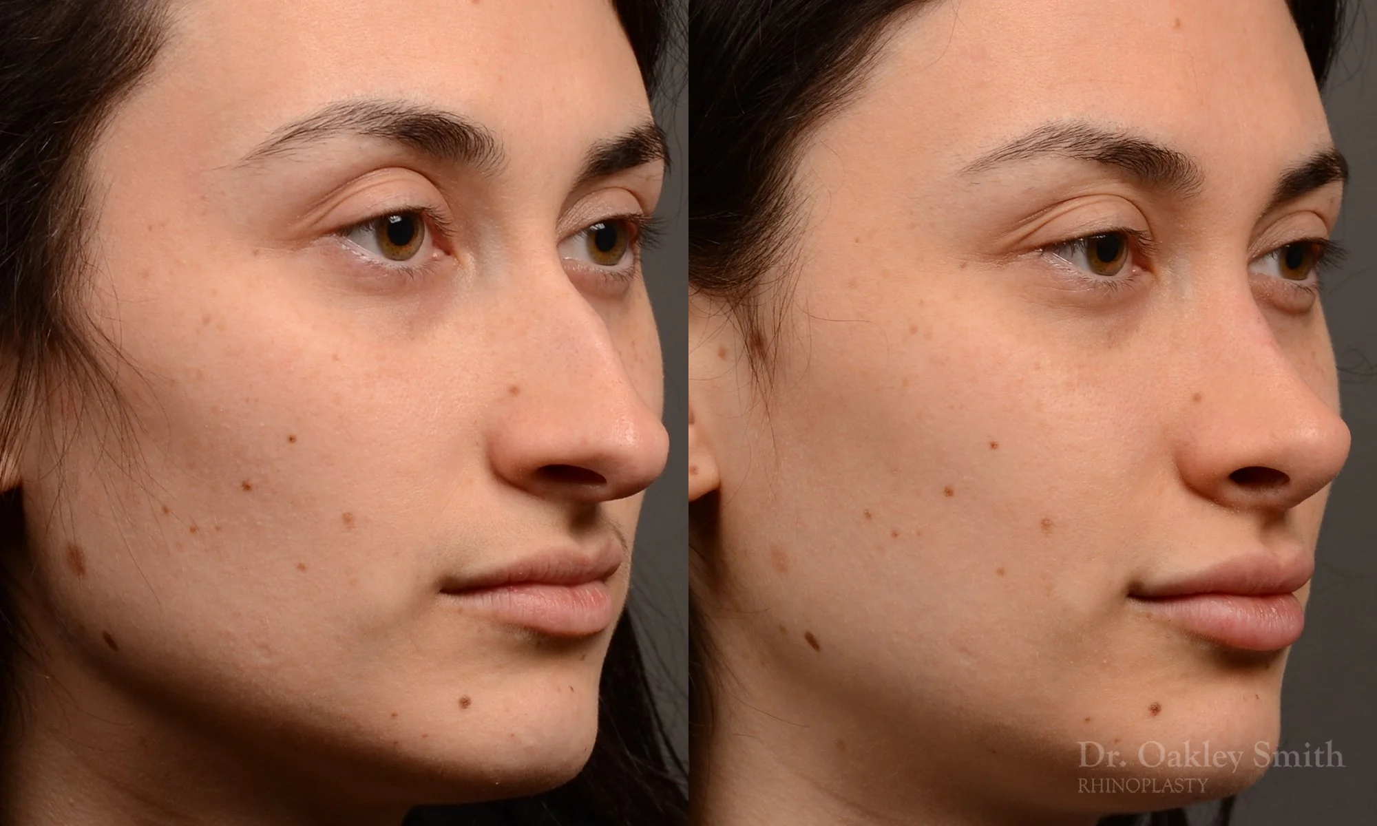 506B-rhinoplasty-dr-oakley-smith-toronto-top-surgeon-nose-job.jpg
