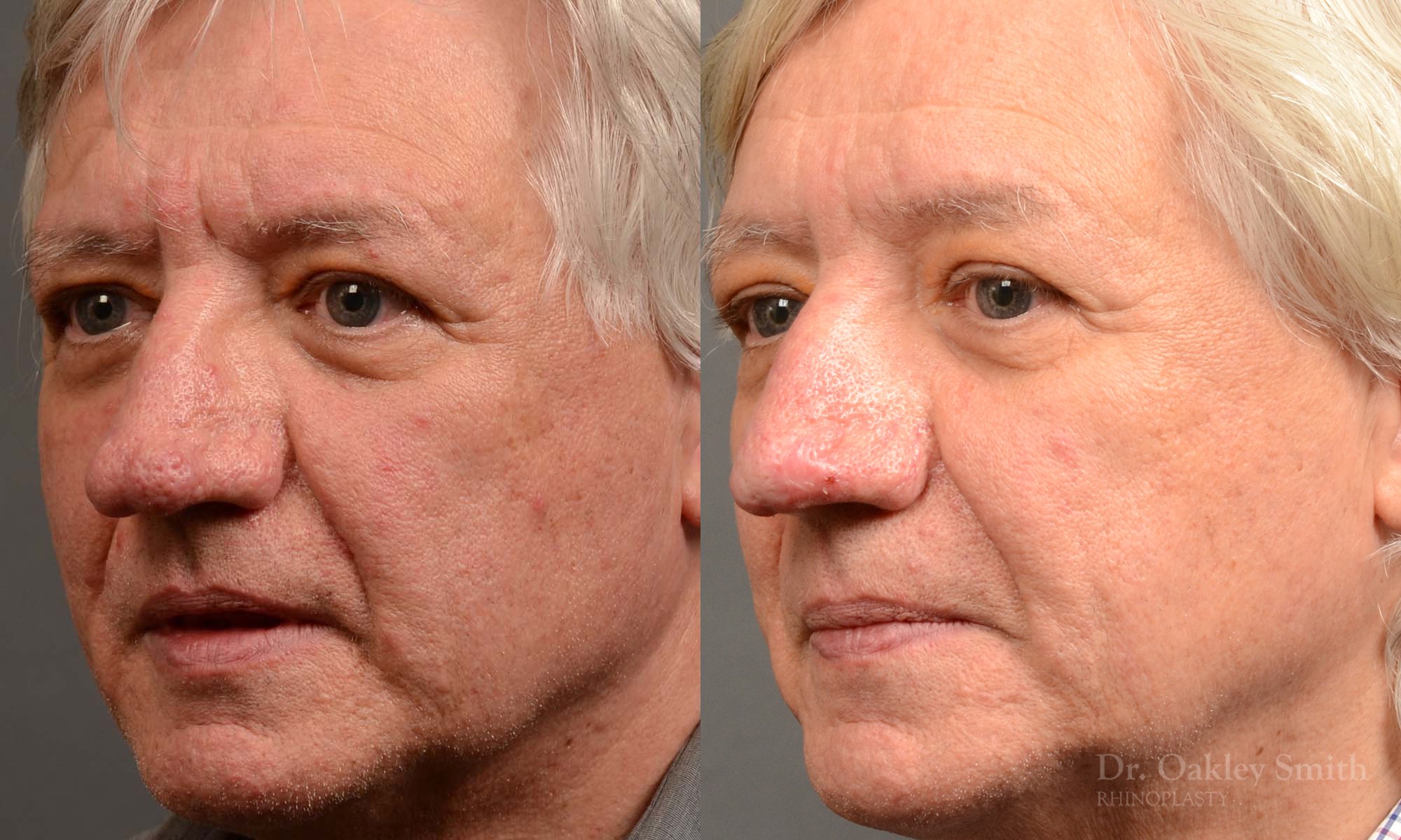 532.1D-Rhinophyma-nose-job-growth-toronto-nose-surgeon-dr-oakley-smith.jpg