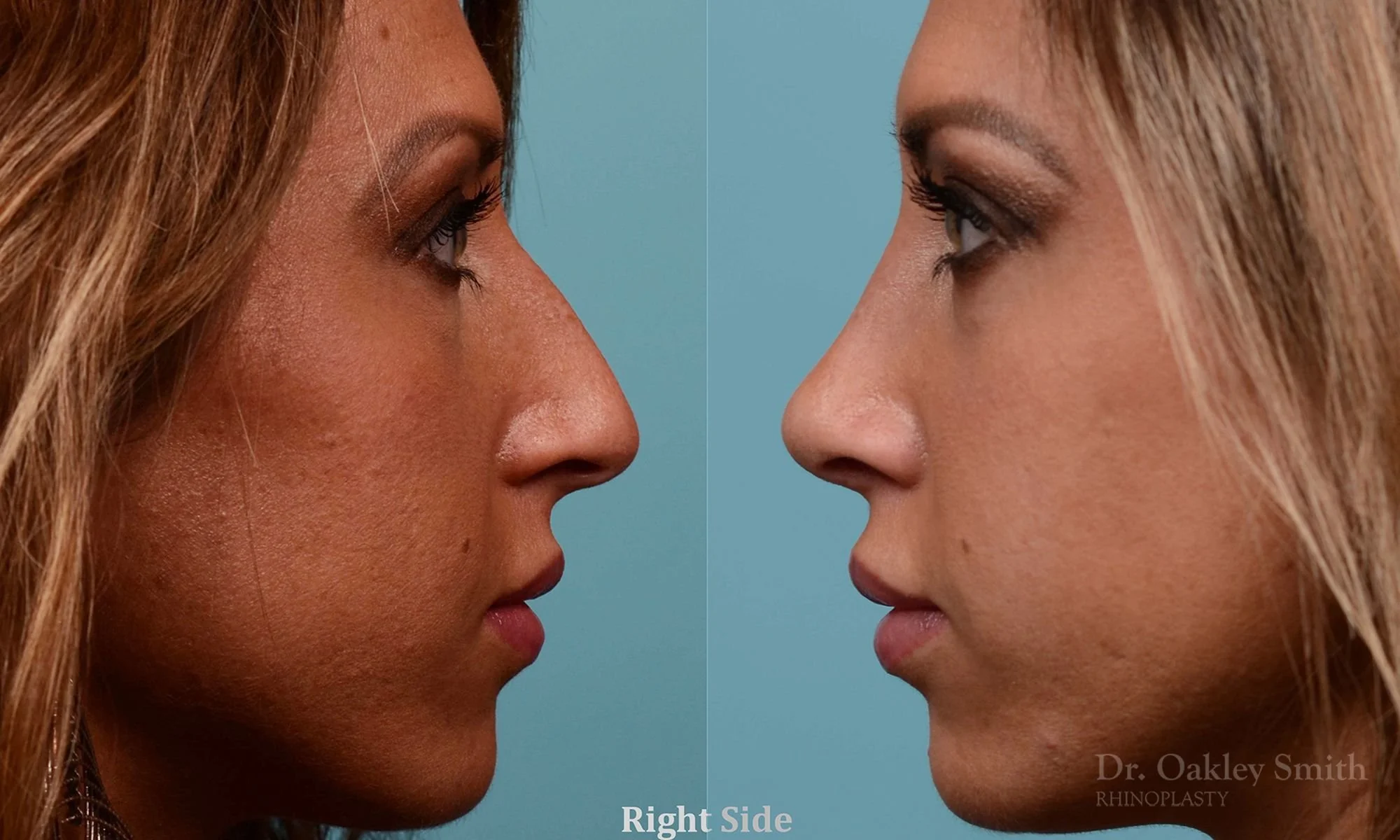 208C-watermark-rhinoplasty-toronto-dr-oakley-smith-female-nose-job-nose-job-big-nose-bump-bridge-1 (1).jpg