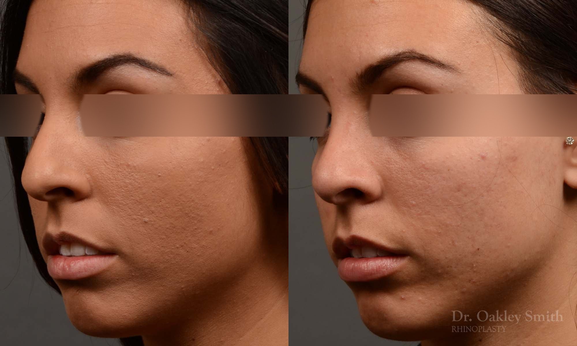 320D-rhinoplasty-dr-oakley-smith-toronto-nose-job.jpg