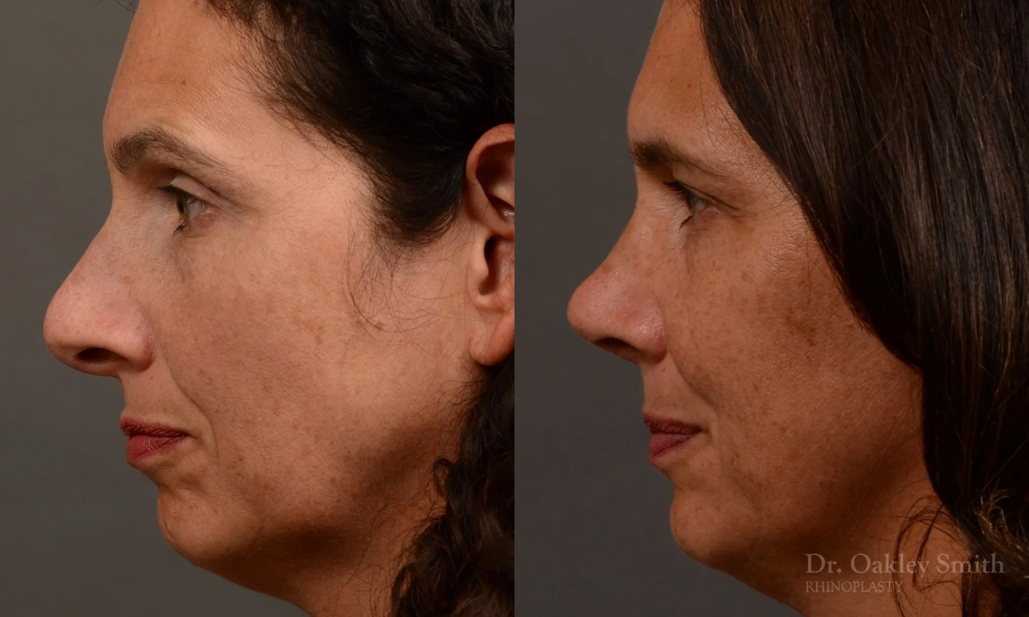 545E-rhinoplasty-nose-job-top-toronto-surgeon-dr.-oakley-smith.jpg