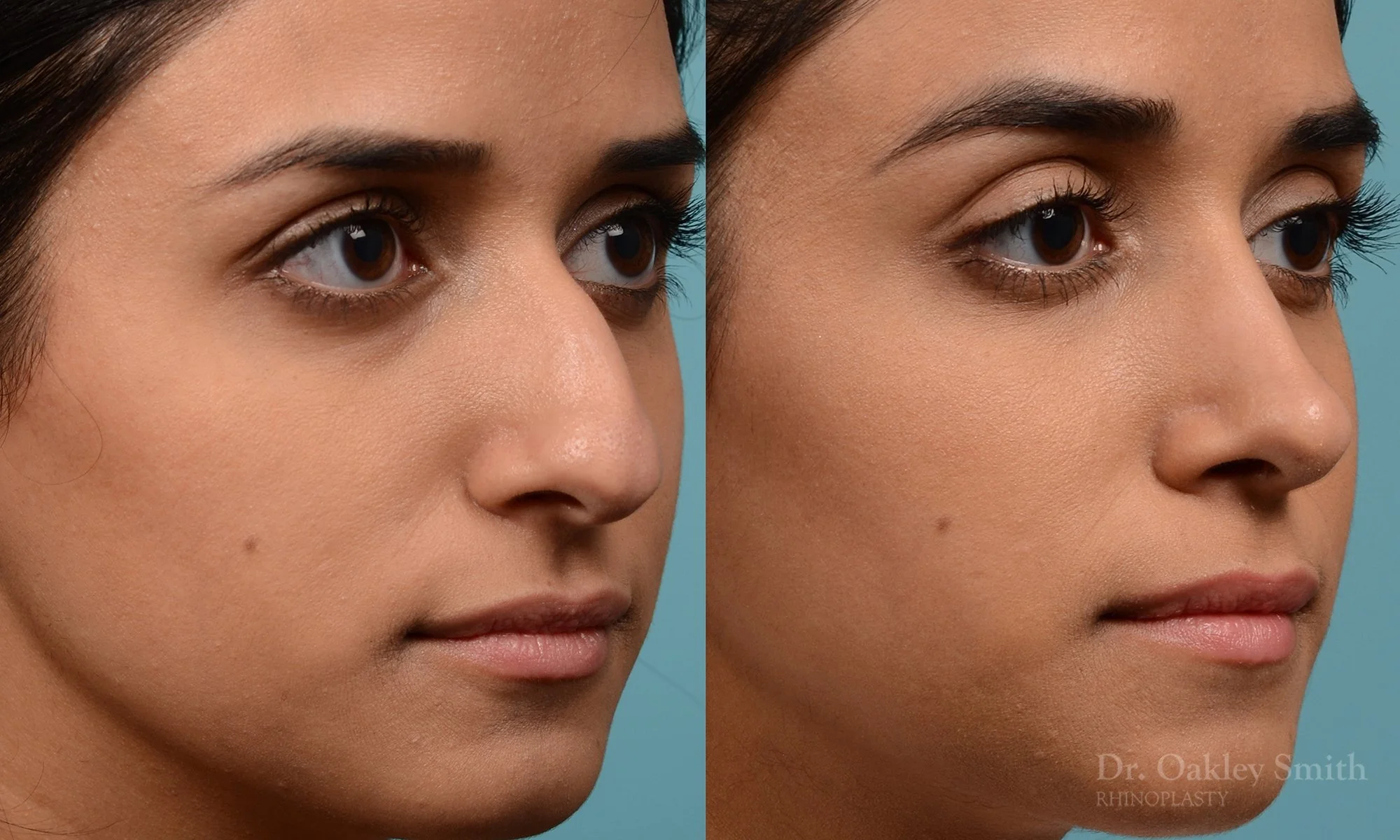 228B-nose-job-rhinoplasty-dr-oakley-smith-toronto-bump-on-the-nose-bridge-bump-4.jpg