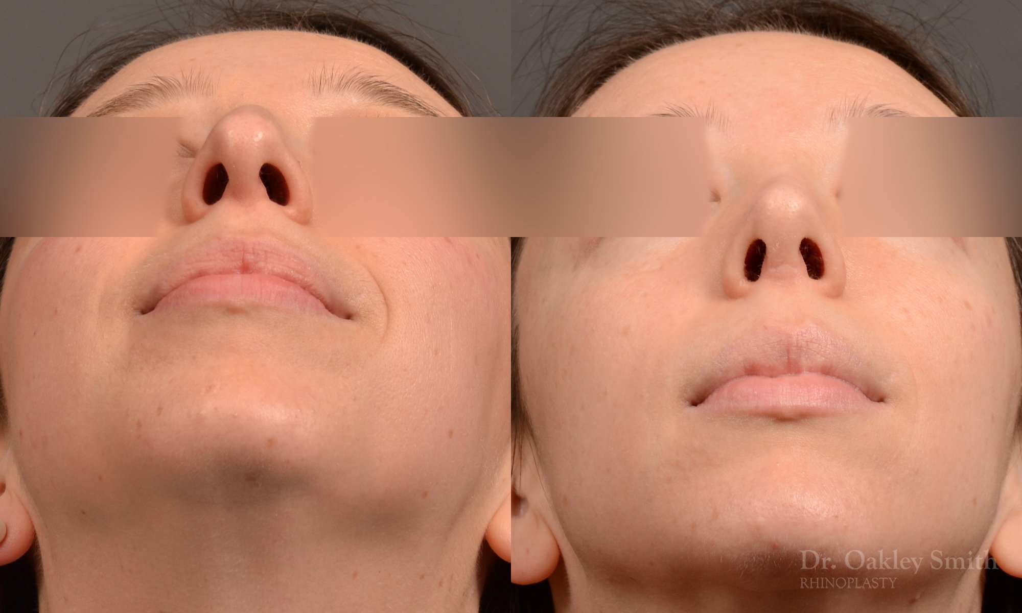 534F-rhinoplasty-dr-oakley-smith-toronto-top-surgeon-nose-job.jpg