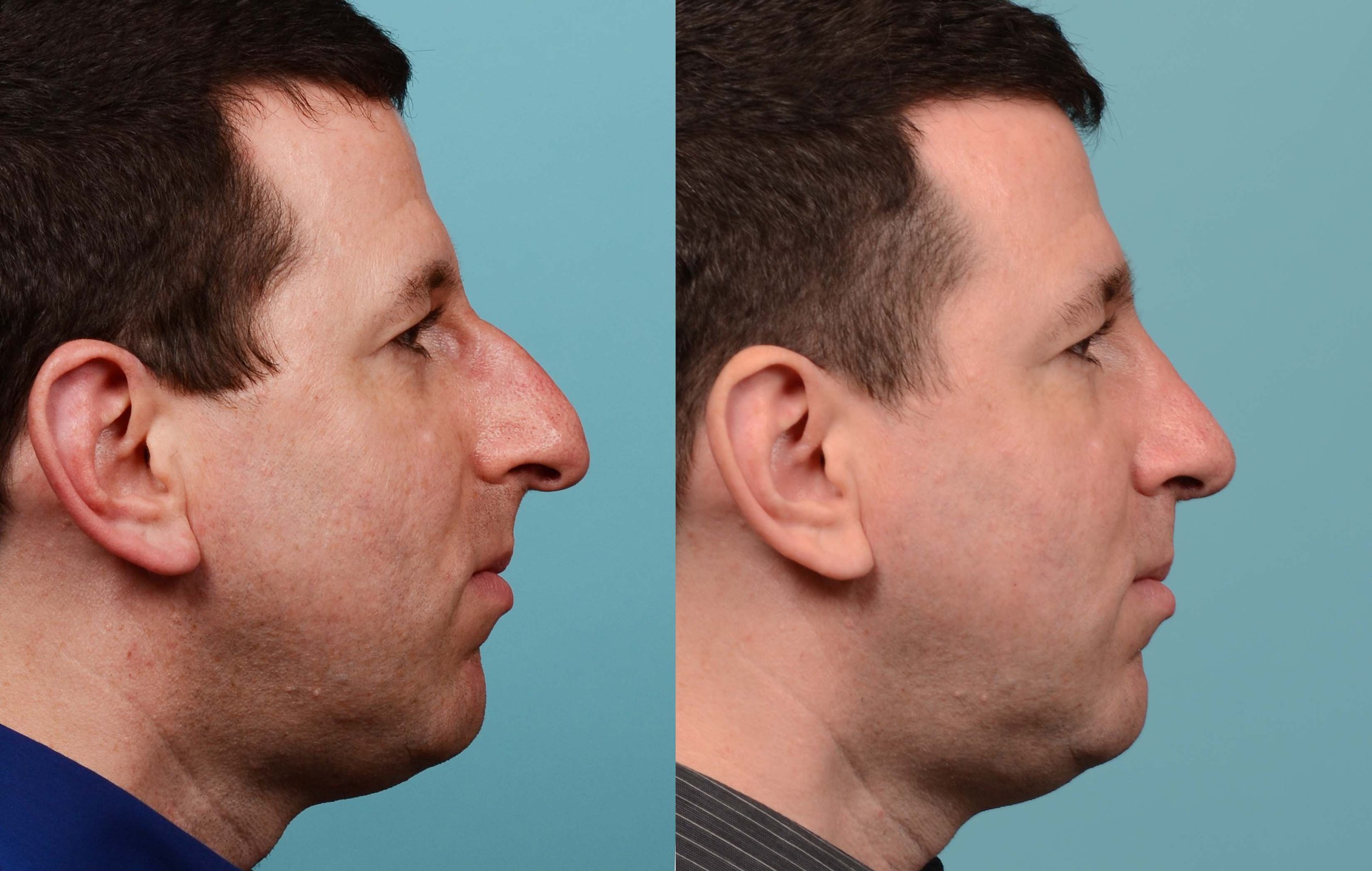 217: Primary Male Rhinoplasty, Thick Skin,  Large Nose, Dorsal Hump