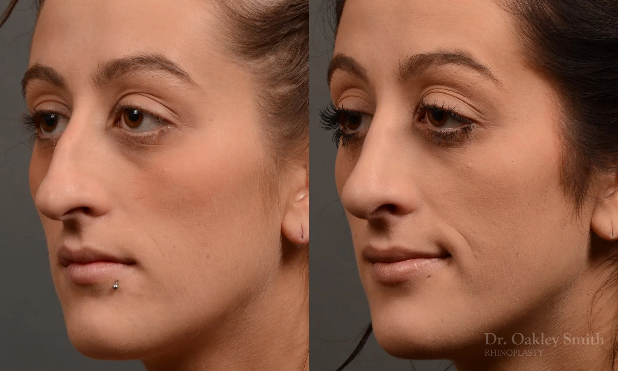 316D-rhinoplasty-dr-oakley-smith-toronto-nose-job.jpg