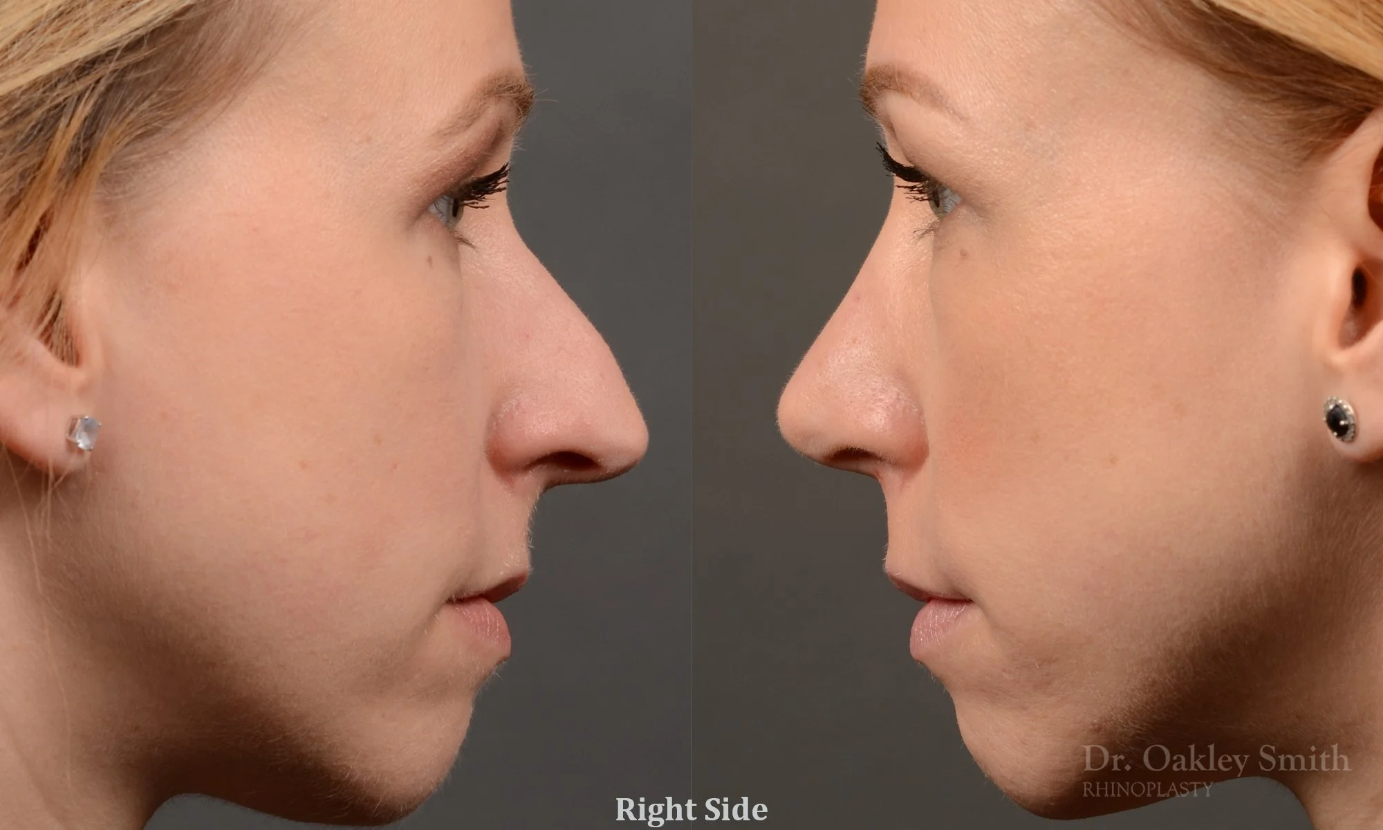 363: Female, Primary Rhinoplasty, Dorsal Hump, Tip Work