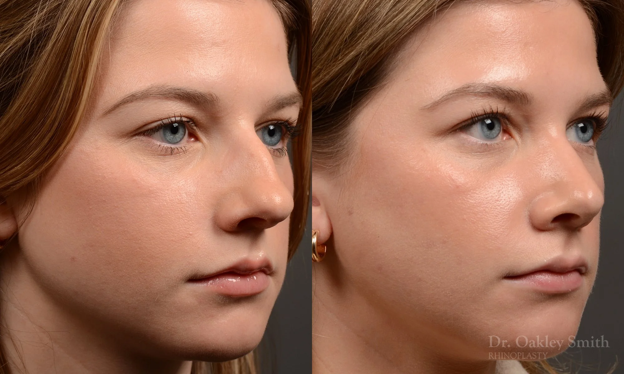 536B-rhinoplasty-dr.-oakley-smith-toronto-nose-job-best.jpg