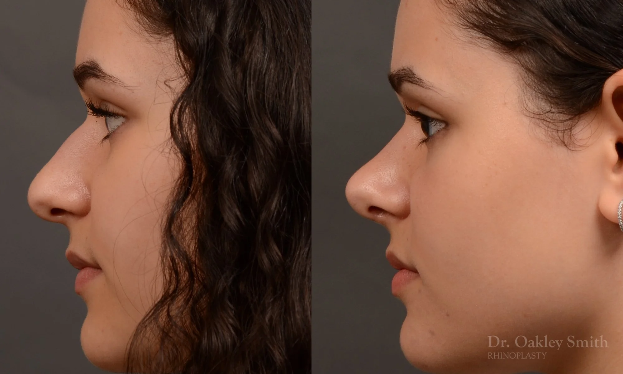 543E-rhinoplasty-before-and-after-nose-job-toronto-Dr.-Oakley-Smith.jpg