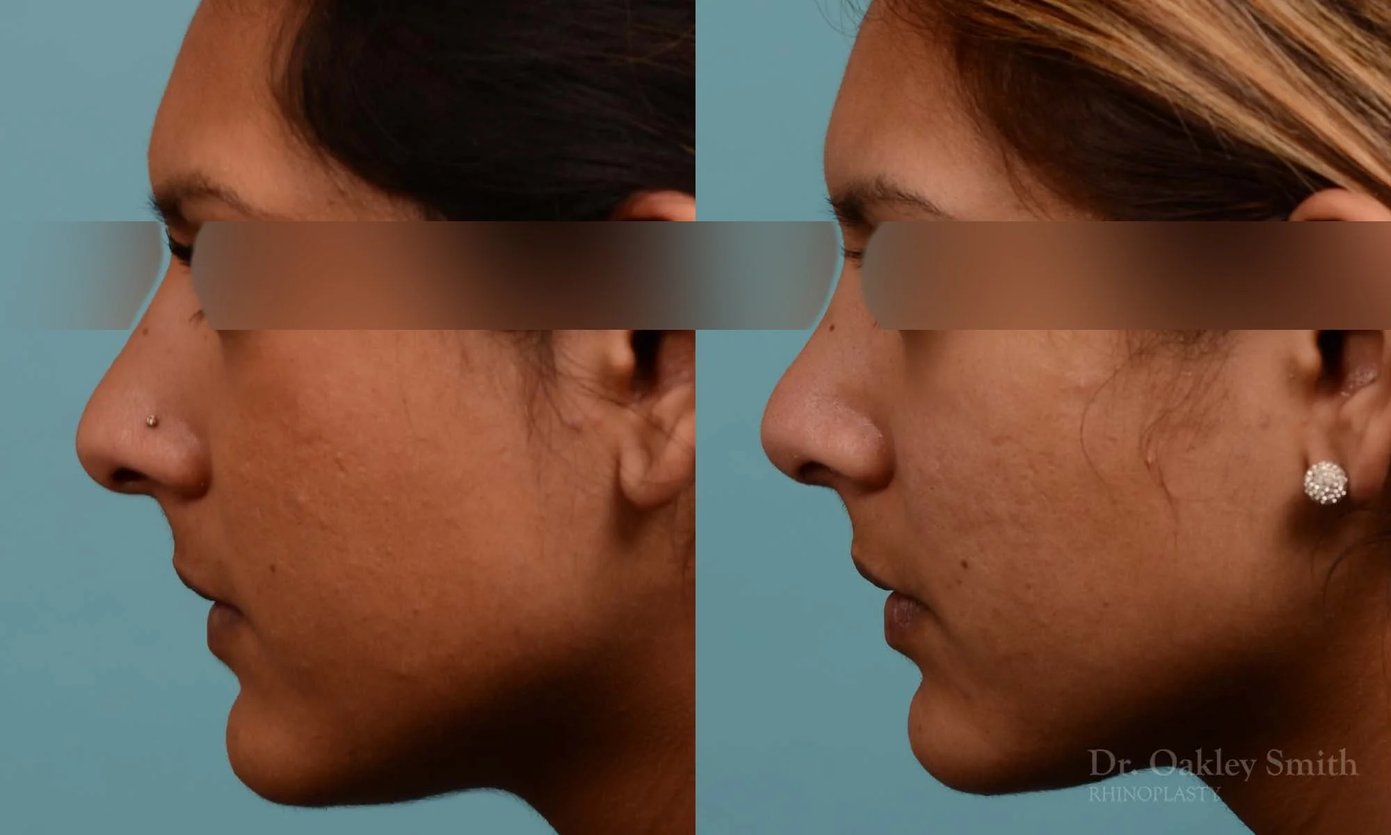 271E-rhinoplasty-dr-oakley-smith-toronto-nose-job.jpg