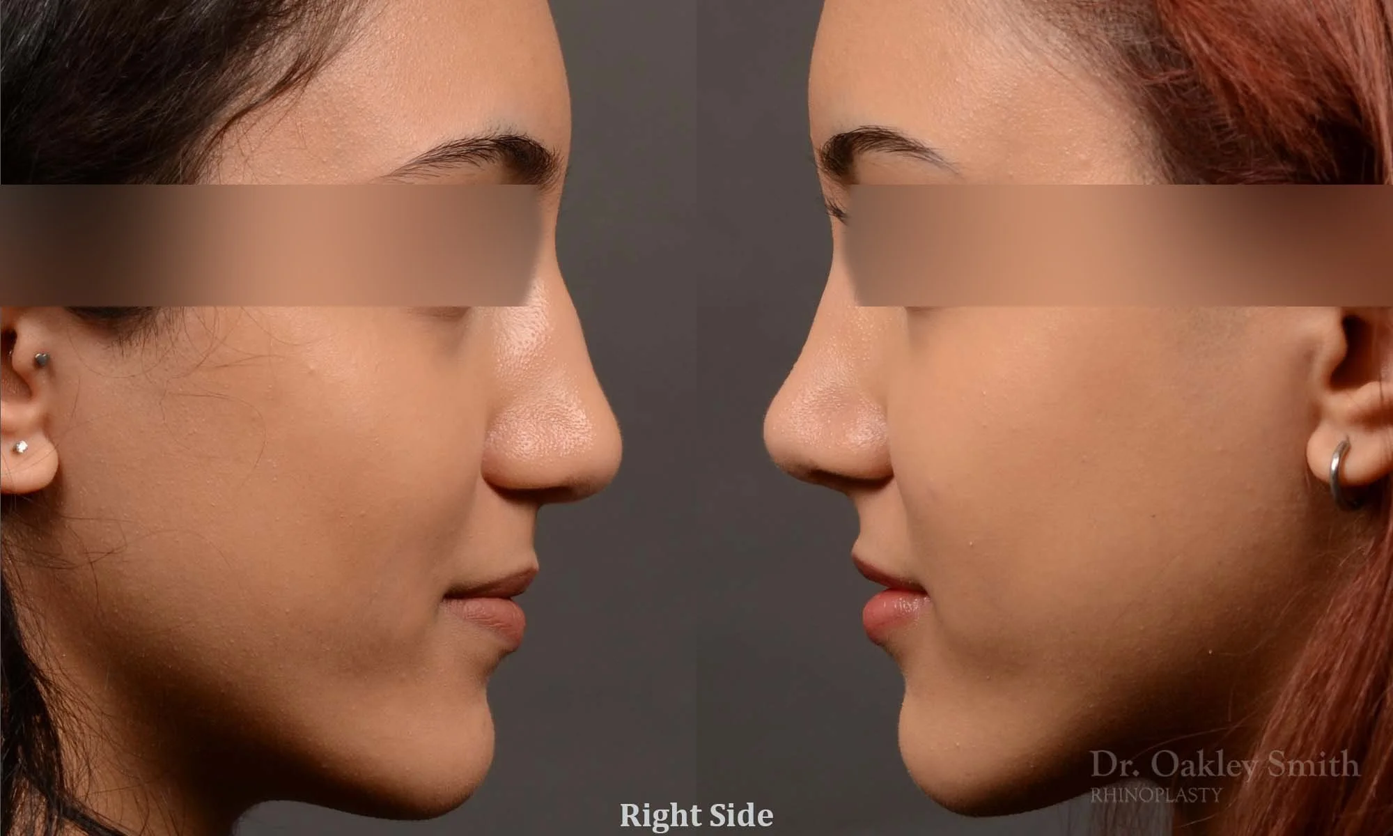 533: Female, Primary Rhinoplasty, Normal Skin, Bridge Work, Tip Work