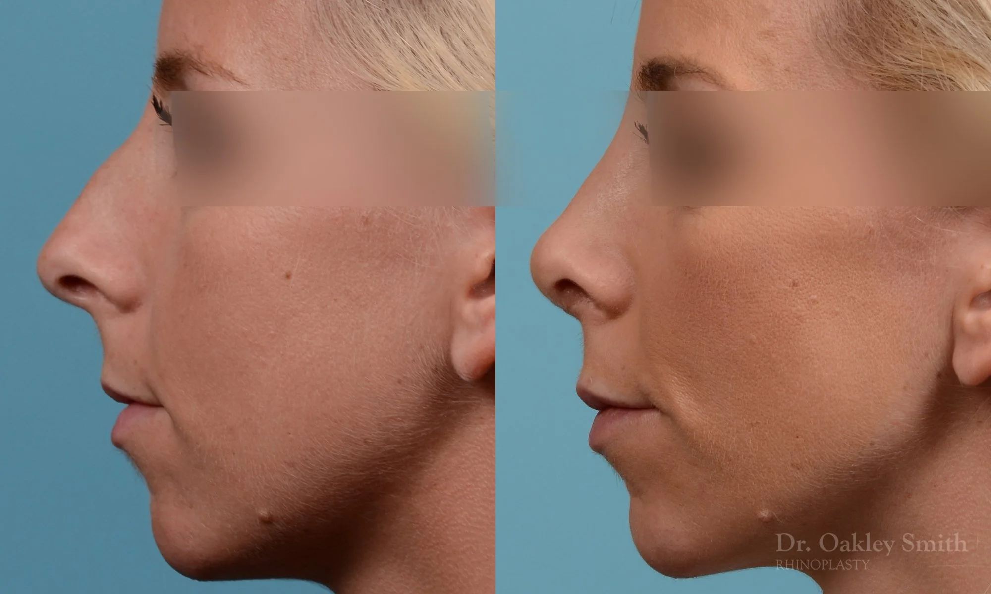 242E-rhinoplasty-dr-oakley-smith-toronto-nose-job-2.jpg