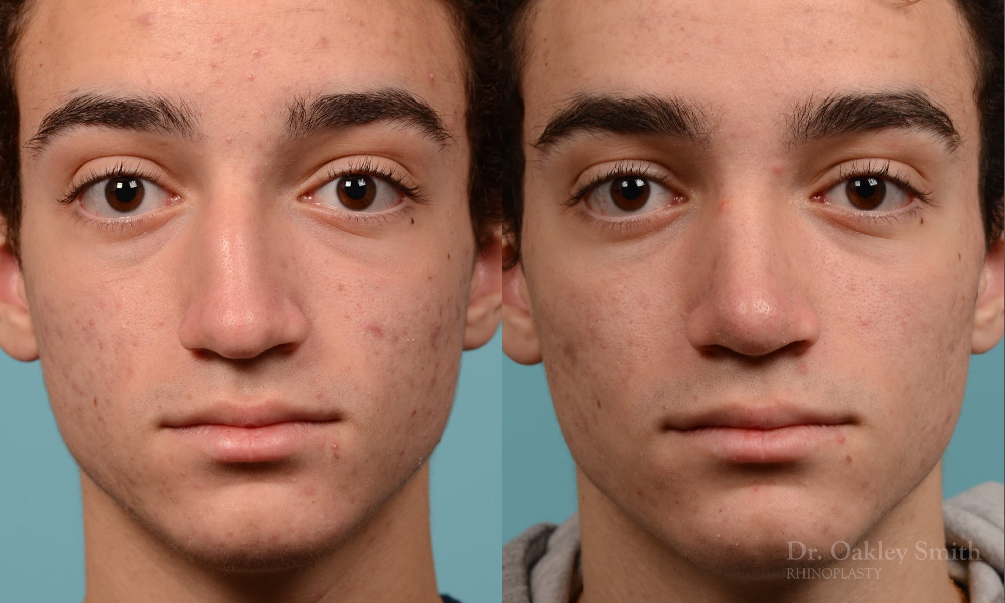 212A-rhinoplasty-dr-oakley-smith-toronto-nose-job.jpg