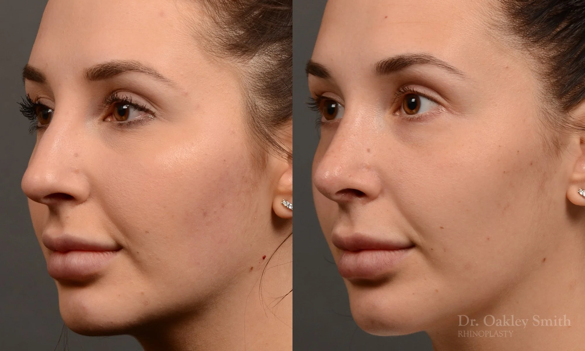 294D-rhinoplasty-dr-oakley-smith-toronto-nose-job.jpg