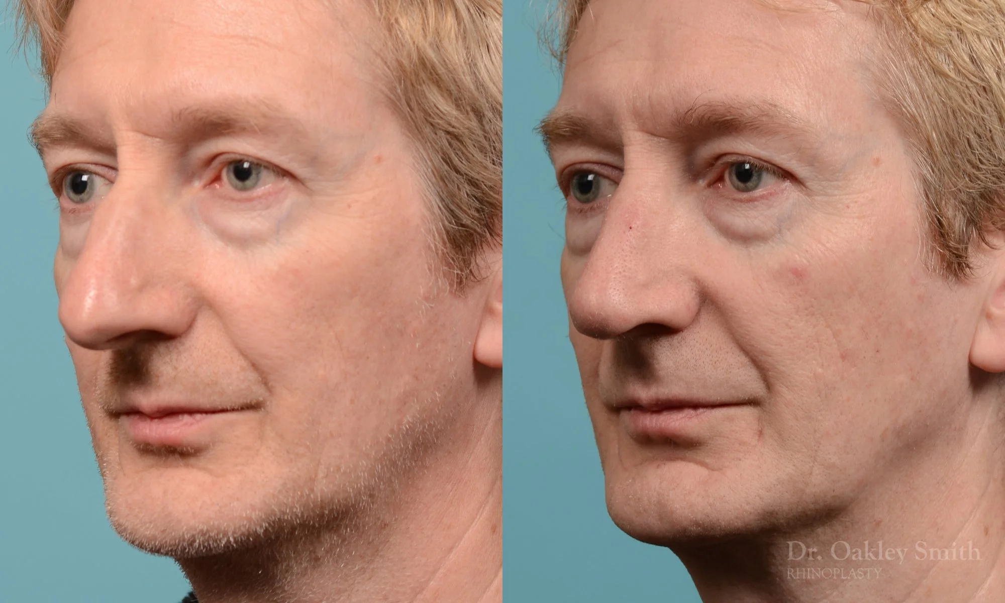 276D-rhinoplasty-dr-oakley-smith-toronot-nose-job.jpg
