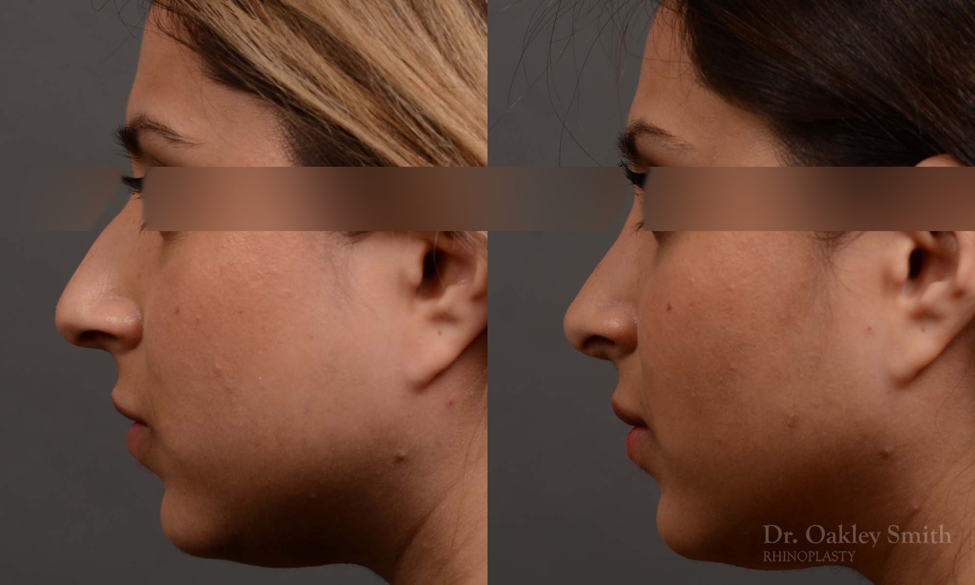 333E-rhinoplasty-dr-oakley-smith-toronto-nose-job.jpg