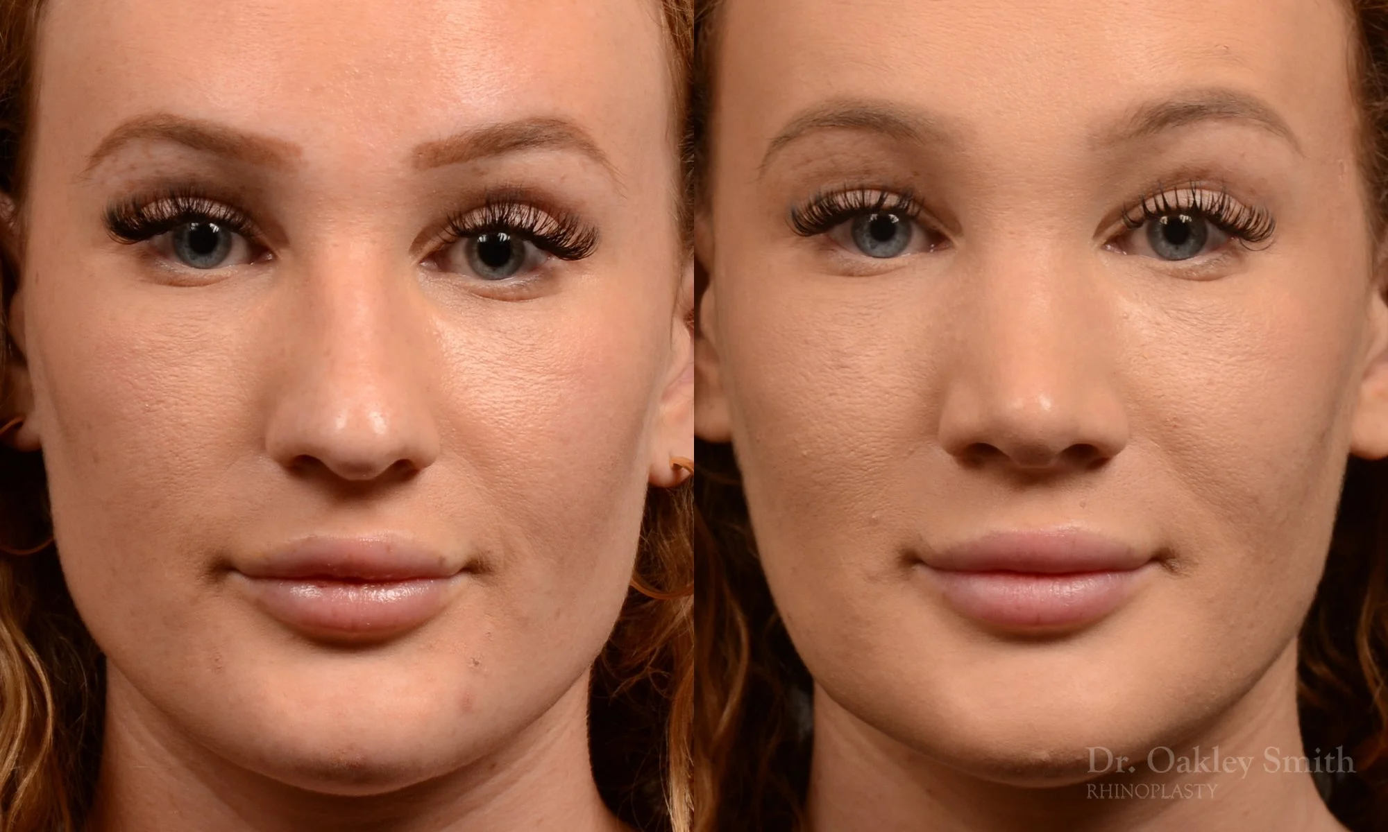 491A-rhinoplasty-dr-oakley-smith-toronto-top-surgeon-nose-job.jpg