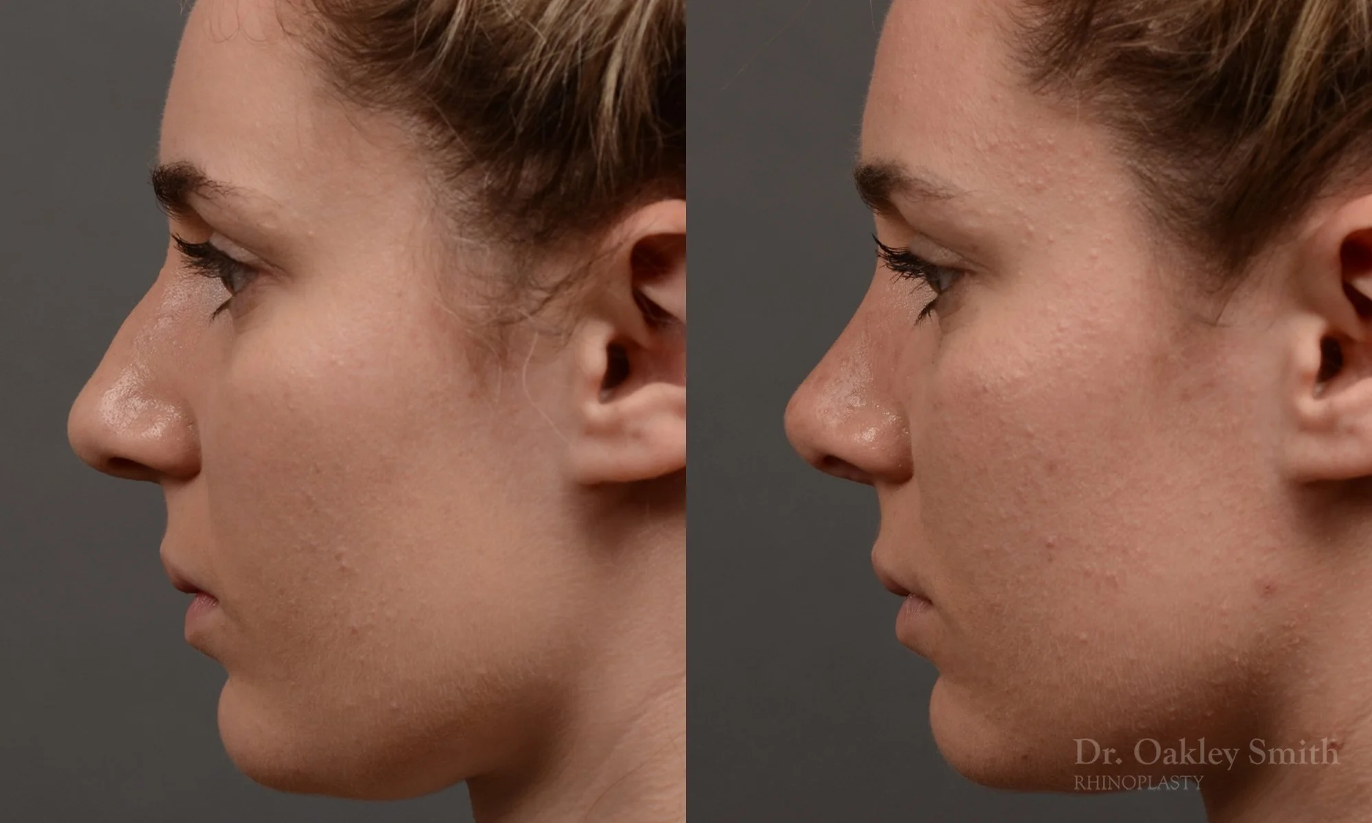 358E-rhinoplasty-dr-oakley-smith-toronto-nose-job.jpg