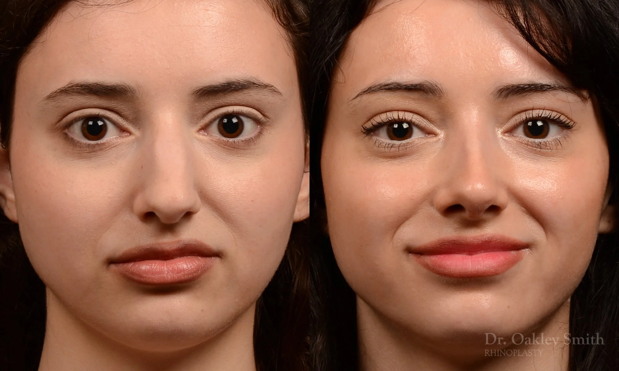 547A-rhinoplasty-dr.-oakley-smith-top-rhino-surgeon-toronto.jpg