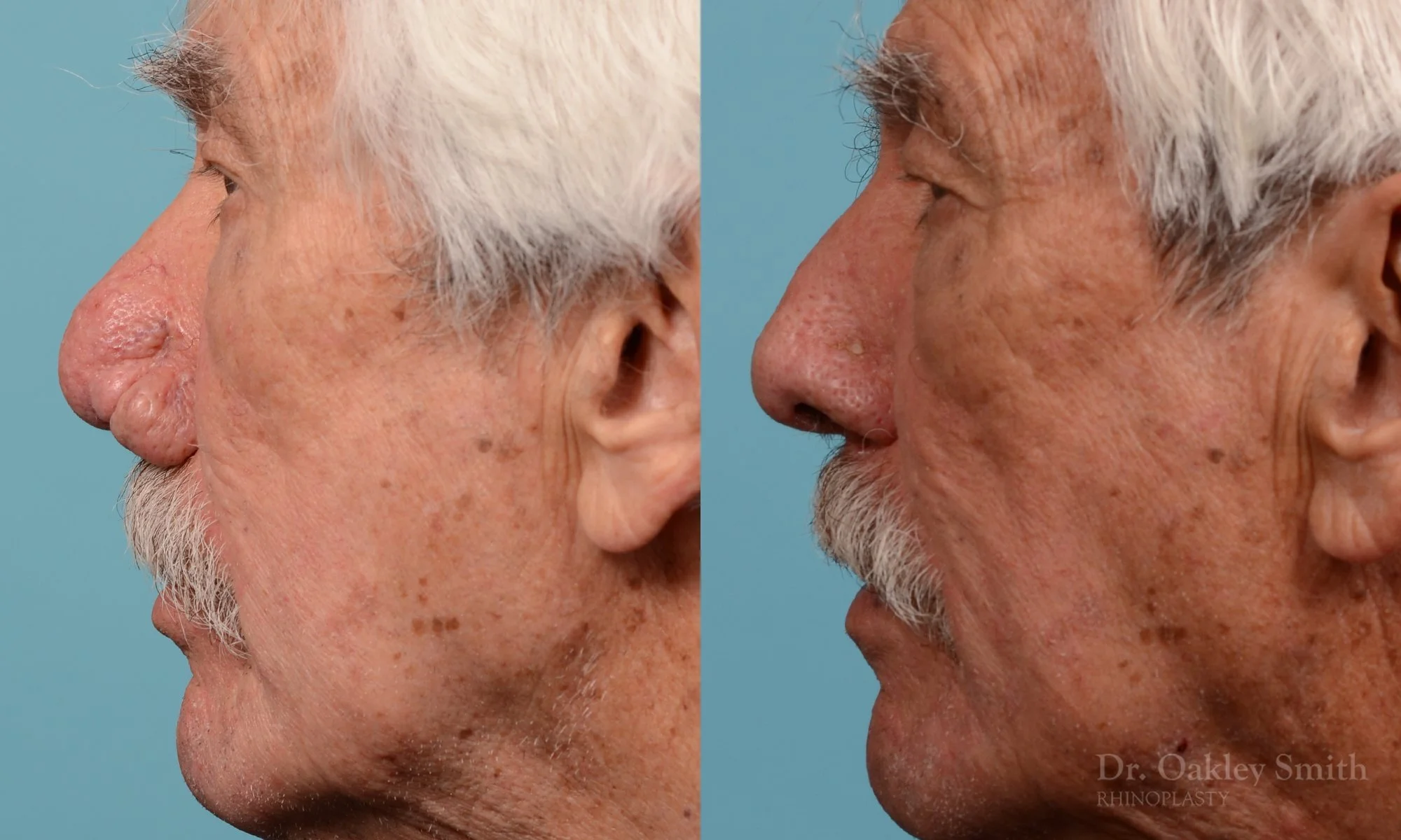 227E-rhinophyma-rhinoplasty-dr-oakley-smith-toronto-nose-job-1.jpg