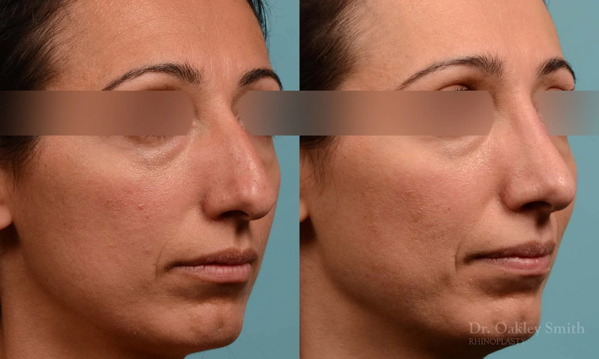 273B-rhinoplasty-dr-oakley-smith-toronto-nose-job.jpg