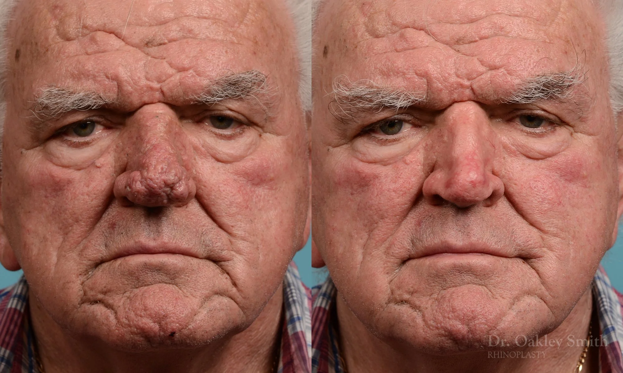 245: Rhinophyma Male