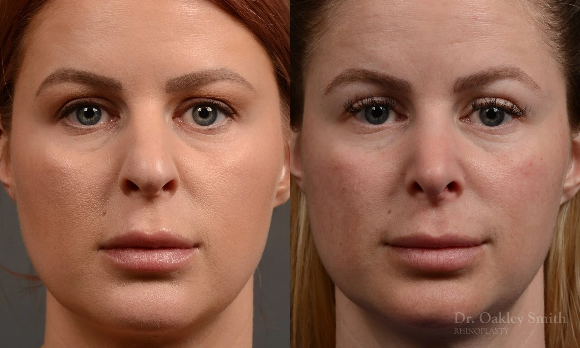 361A-rhinoplasty-dr-oakley-smith-toronto-nose-job.jpg