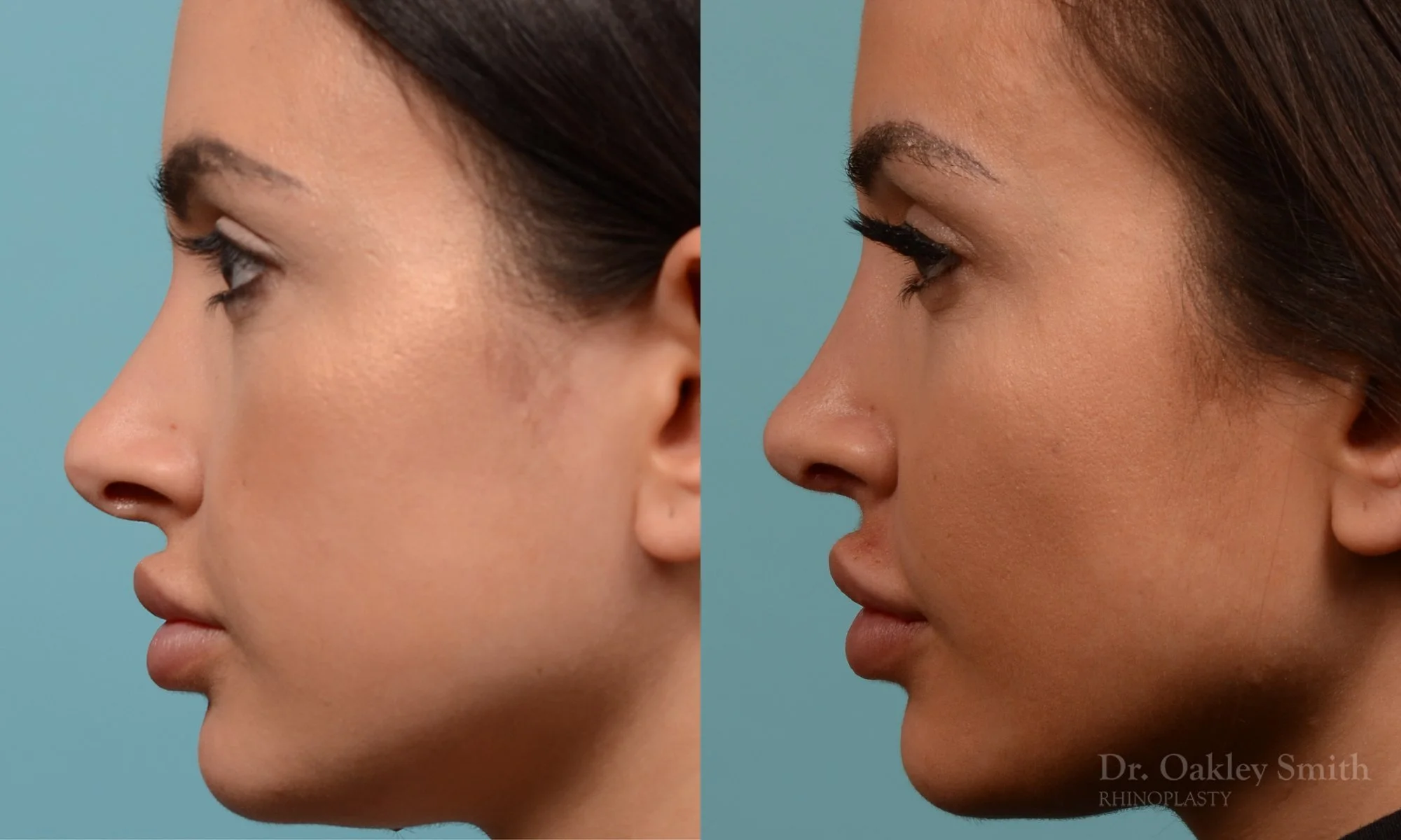 259E-rhinoplasty-dr-oakley-smith-toronto-nose-job.jpg