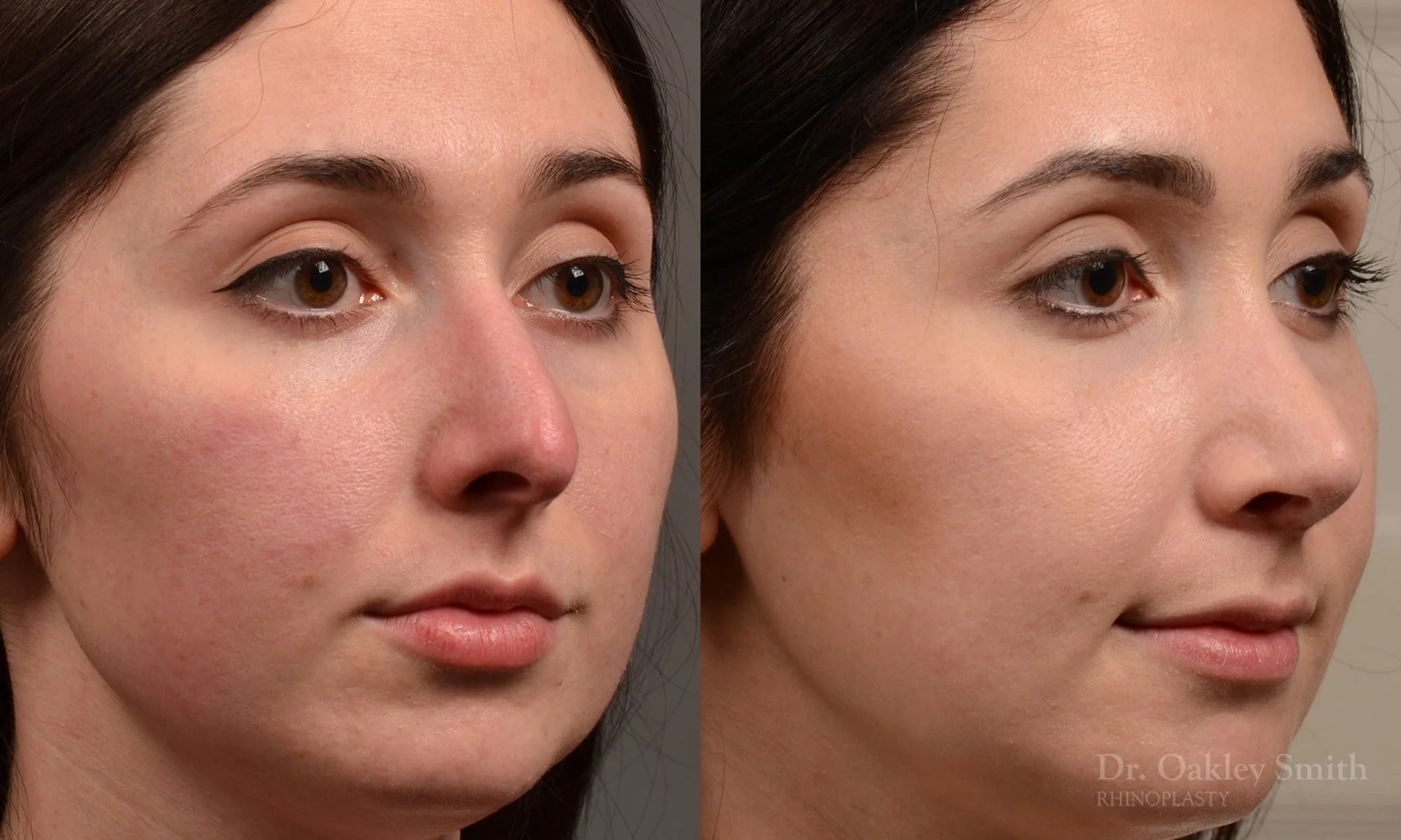 476B-rhinoplasty-dr-oakley-smith-toronto-top-surgeon-nose-job.jpg