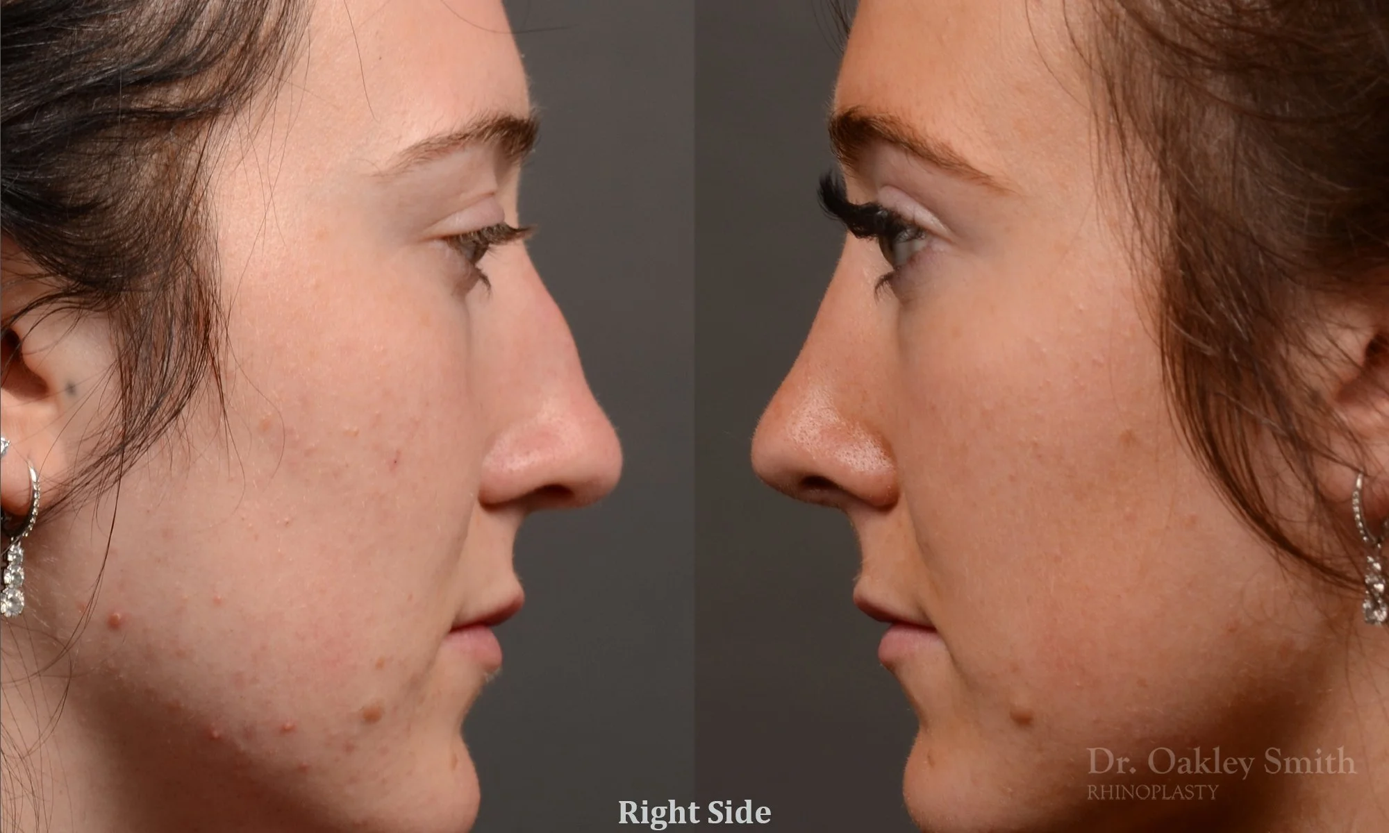 484: Female, Primary  Rhinoplasty, Thin Skin, Bridge Work, Tip Work, Crooked