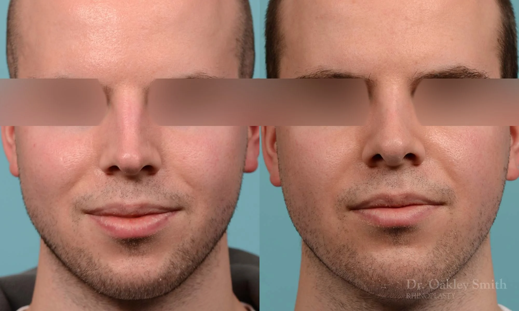 278A-rhinoplasty-dr-oakley-smith-toronto-male-nose-job.jpg