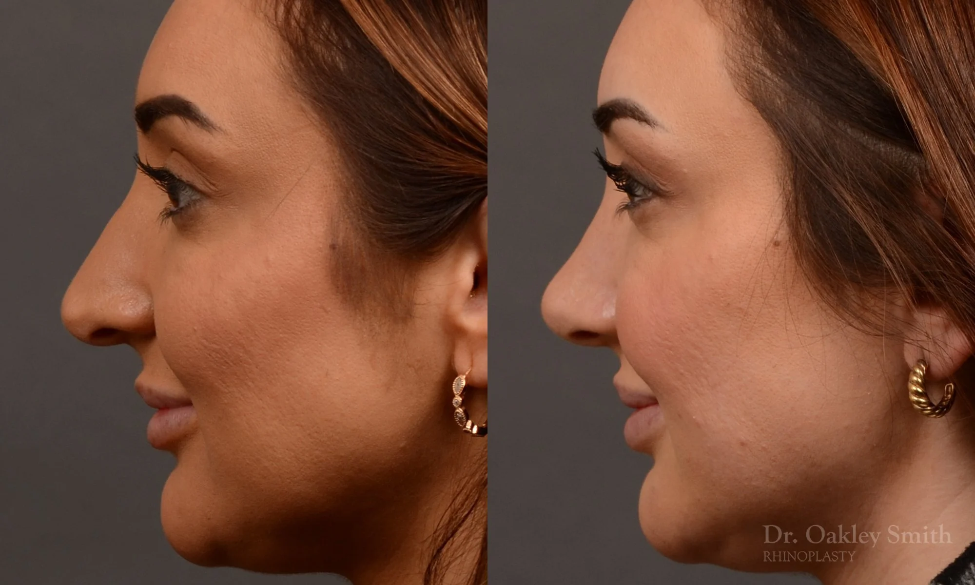 502E-rhinoplasty-dr-oakley-smith-toronto-top-surgeon-nose-job.jpg