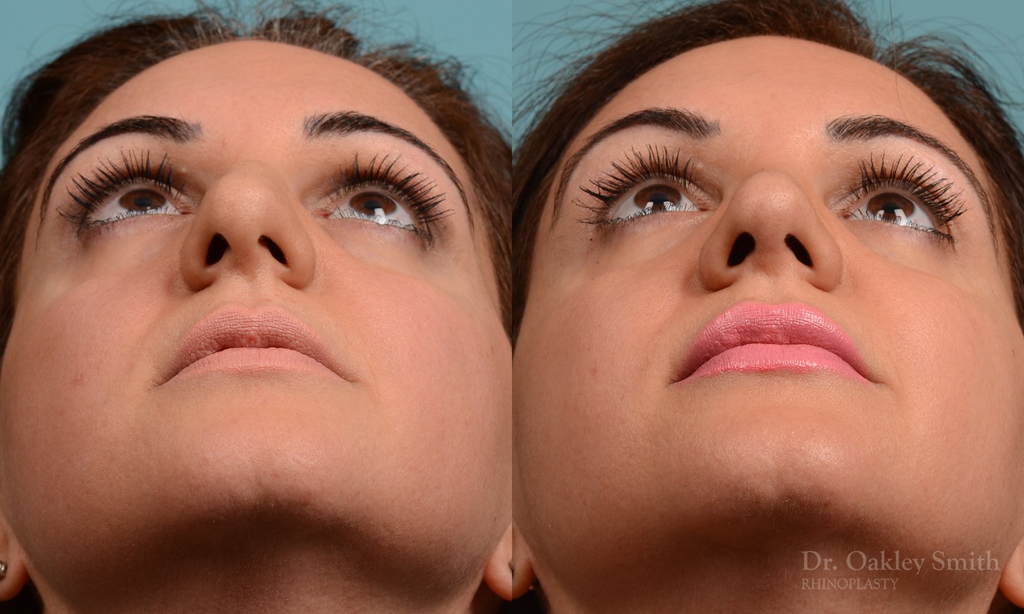 311F-rhinoplasty-dr-oakley-smith-toronto-nose-job.jpg