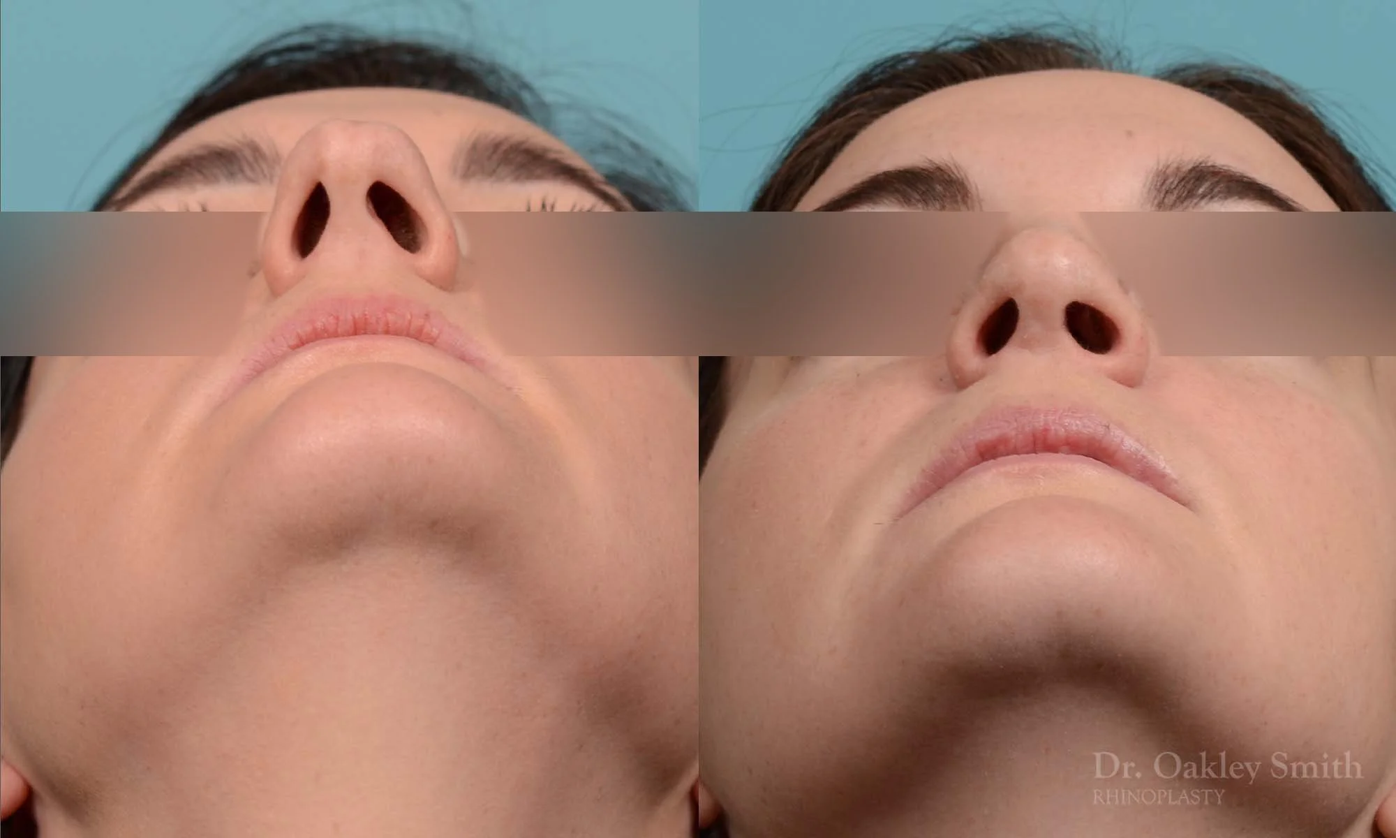252F-rhinoplasty-dr-oakley-smith-toronto-nose-job.jpg