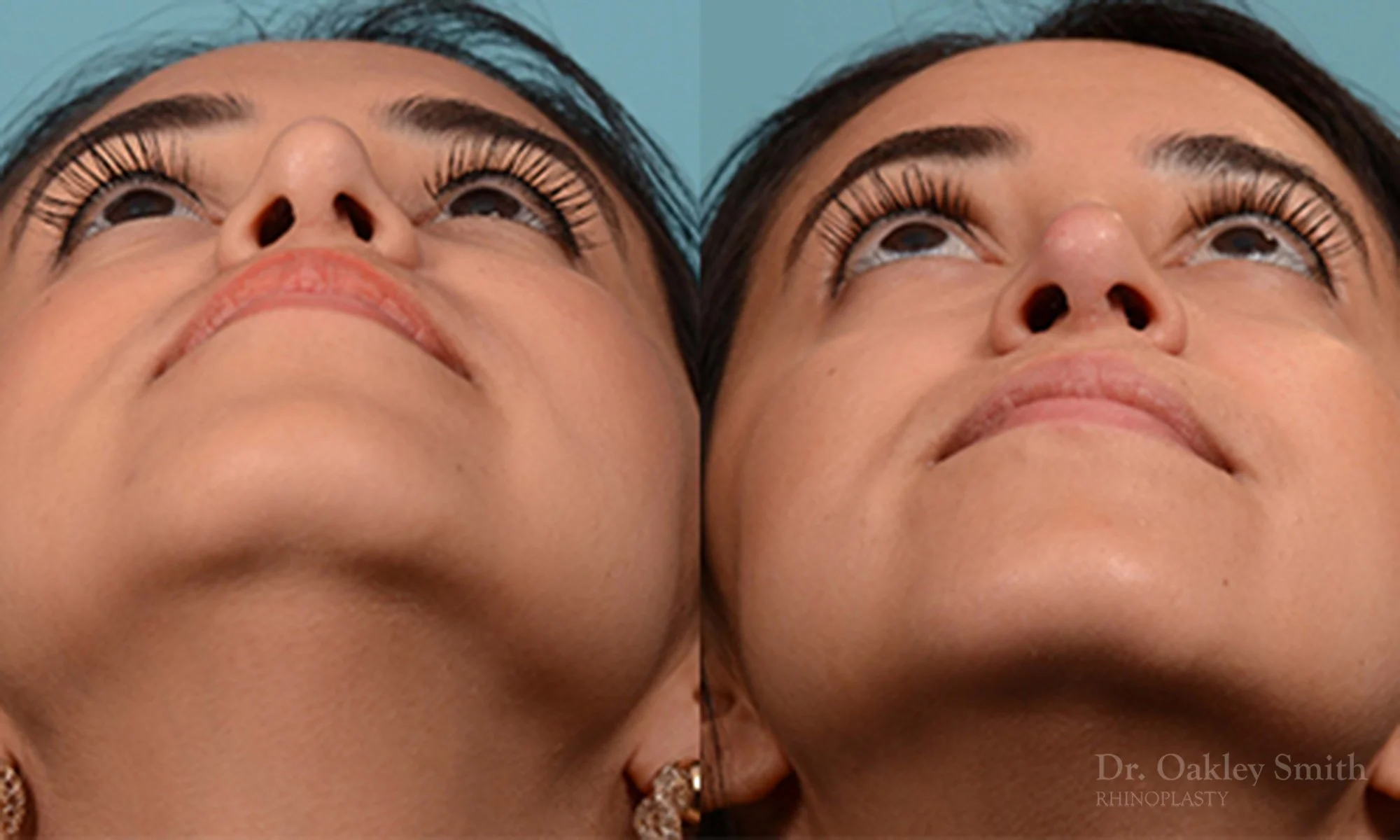226F-rhinoplasty-dr-oakley-smith-toronto-nose-job-1.jpg
