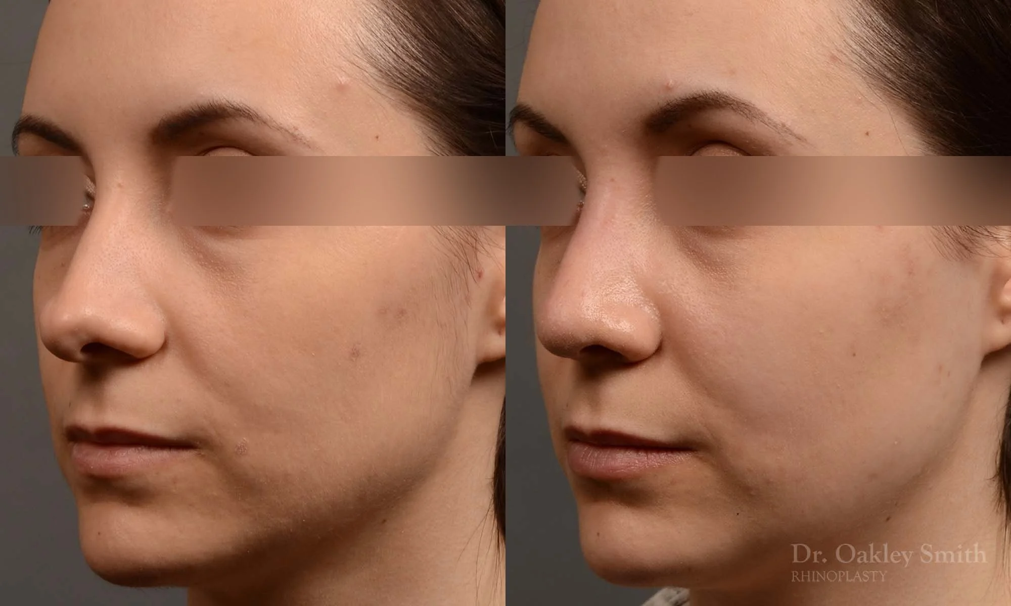 341D-rhinoplasty-dr-oakley-smith-toronto-nose-job.jpg