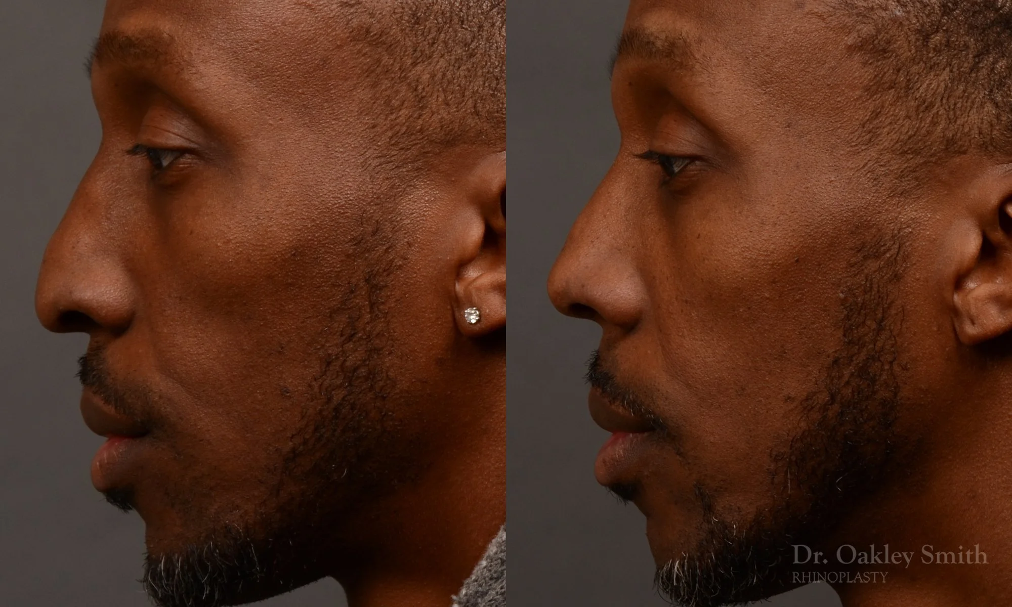 504E-malerhinoplasty-dr-oakley-smith-toronto-top-surgeon-nose-job.jpg