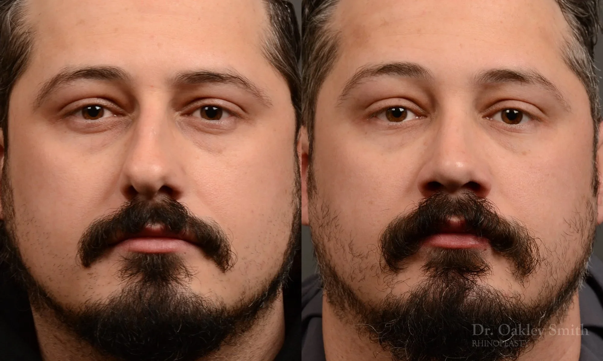 501: Primary Male Rhinoplasty, Normal Skin, Bridge Work, Tip Work, Crooked