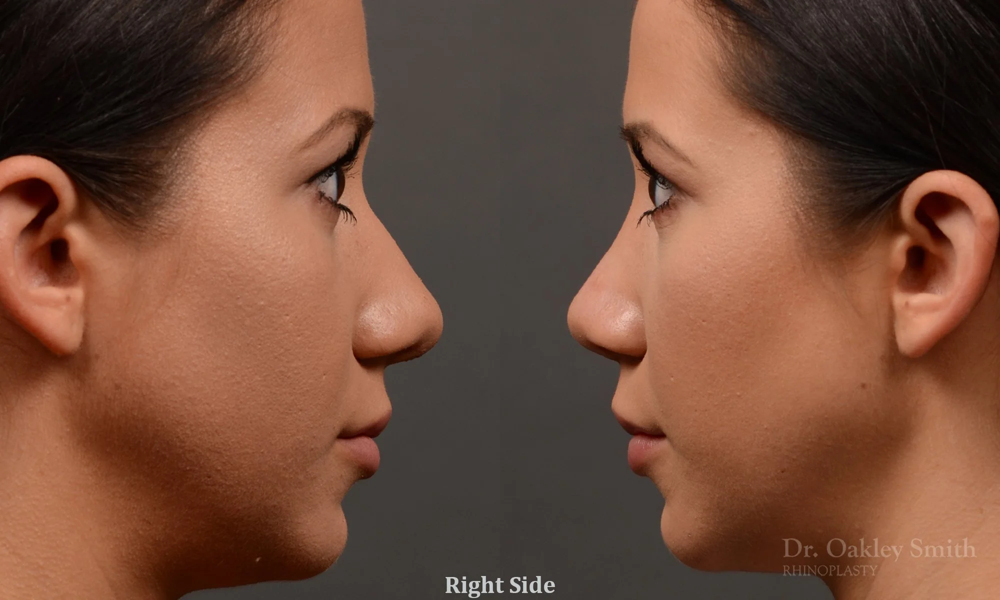 328: Female, Ethnic Rhinoplasty, Dorsal Hump, Tip Refinement
